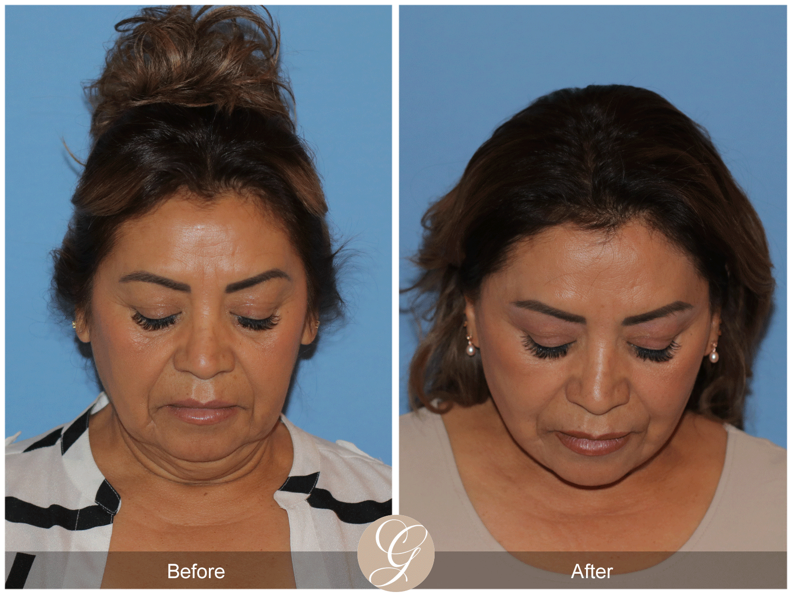 Preservation Deep Plane Facelift Case 41 Image