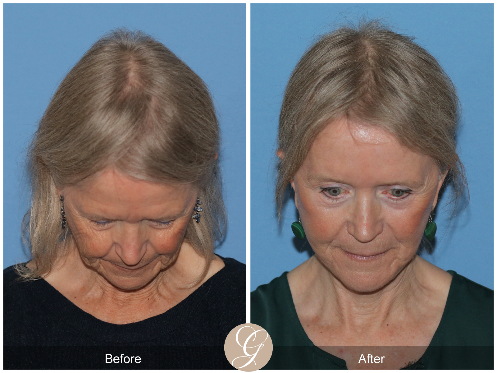 Preservation Deep Plane Facelift Case 42 Image