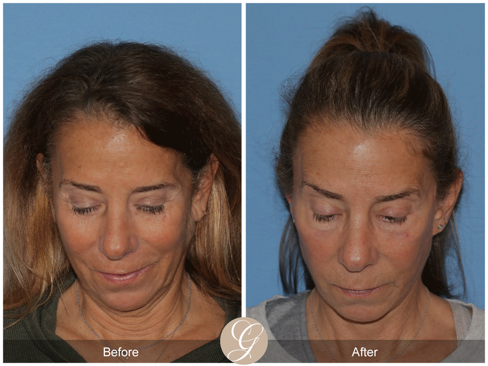 Preservation Deep Plane Facelift Case 43 Image