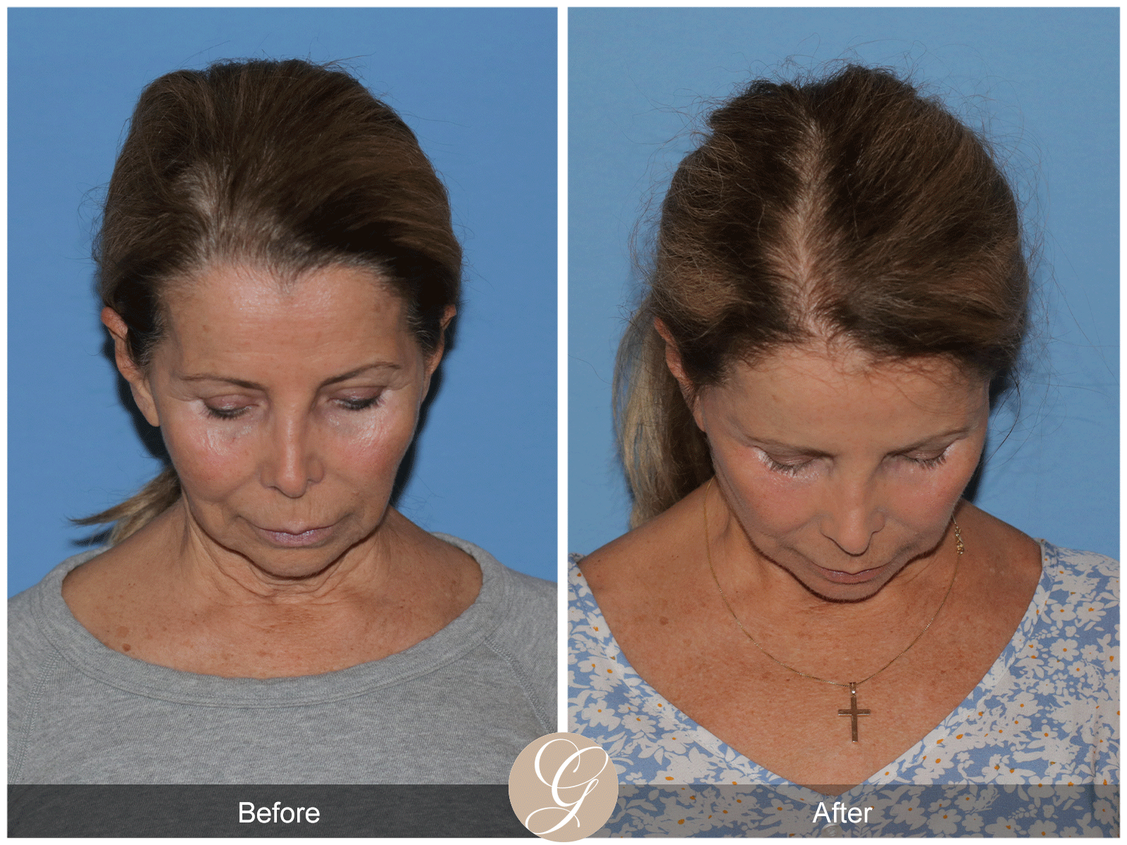 Preservation Deep Plane Facelift Case 44 Image