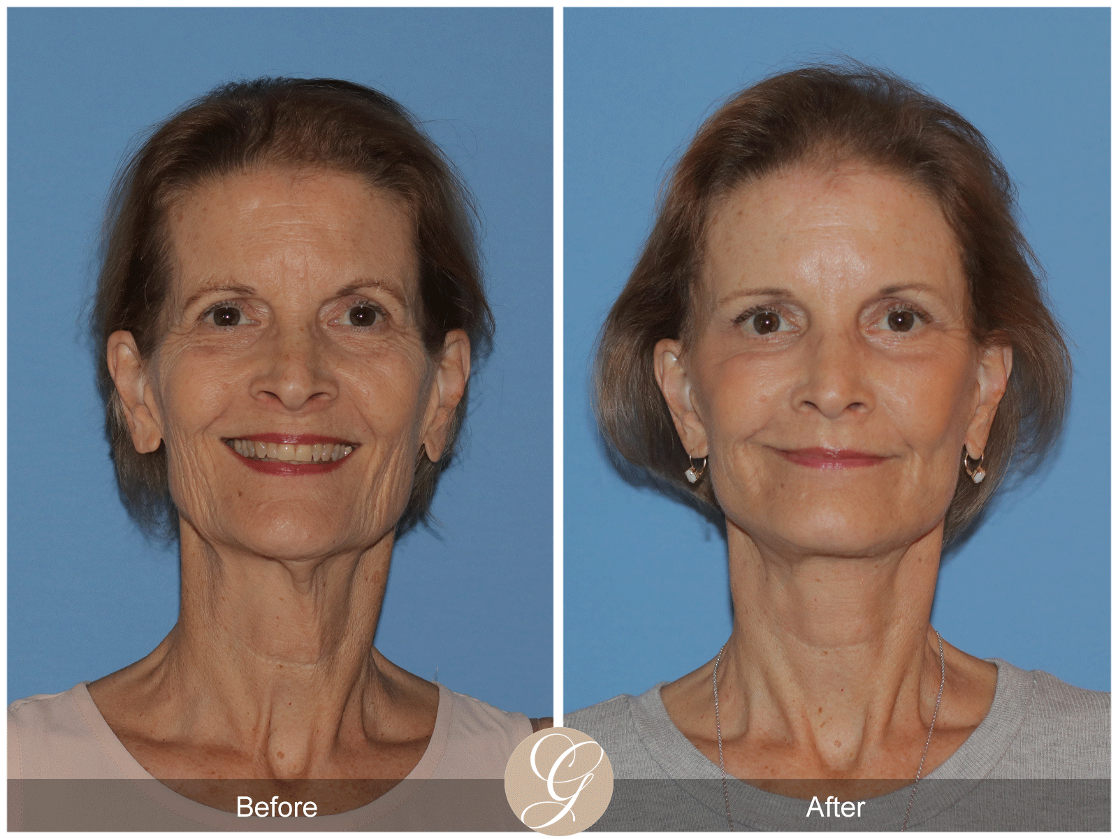 Deep Plane Facelift Case 36 Image