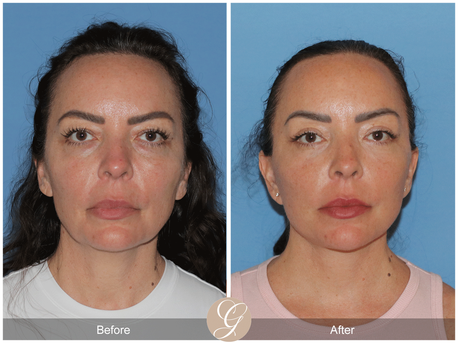 Preservation Deep Plane Facelift Case 46 Image