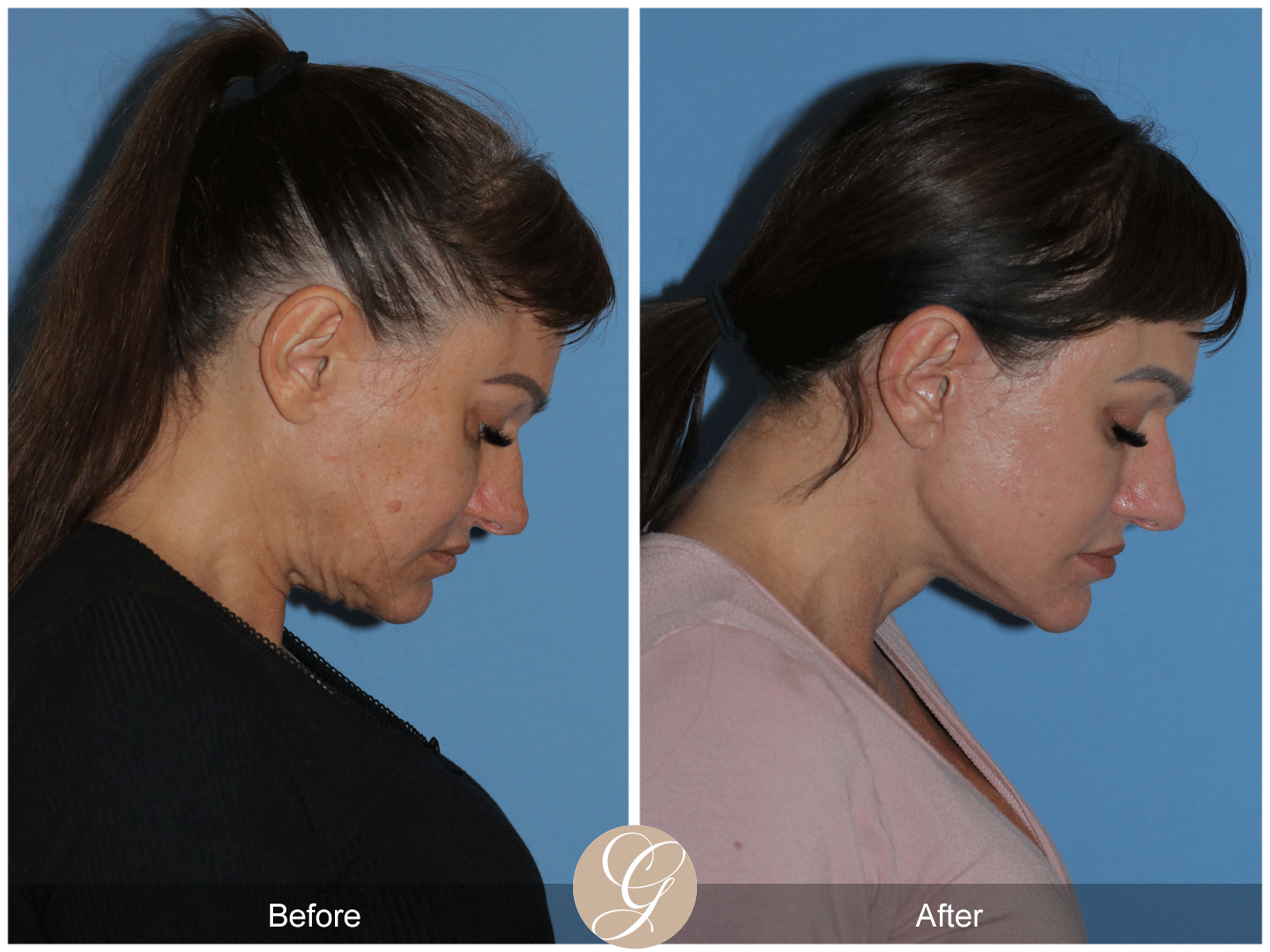 Preservation Deep Plane Facelift Case 47 Image