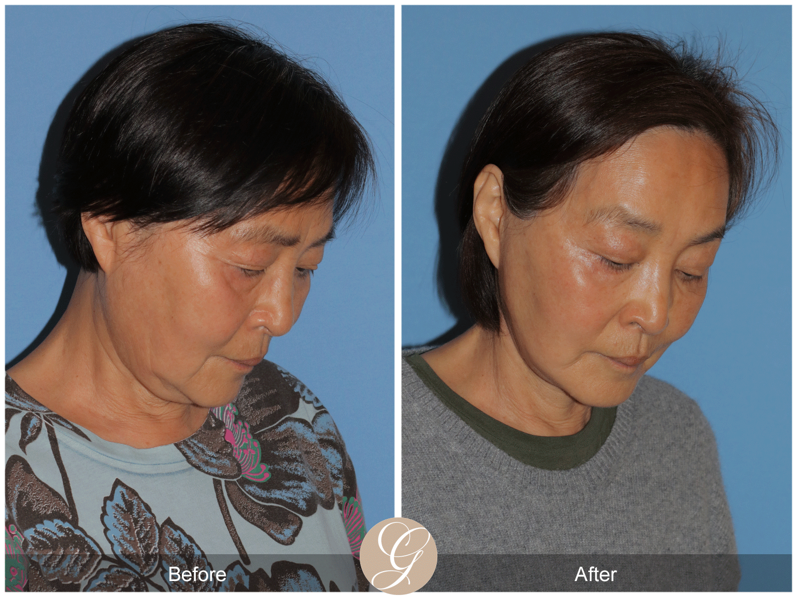 Deep Plane Facelift Case 45 Image