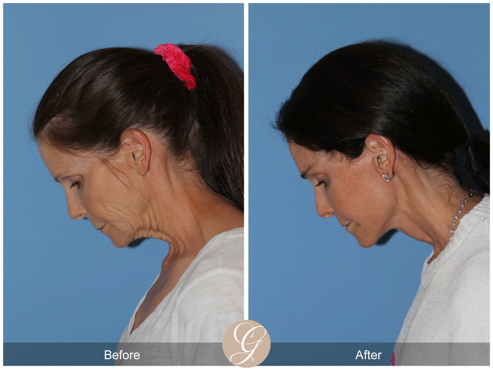 Deep Plane Facelift Case 46 Image