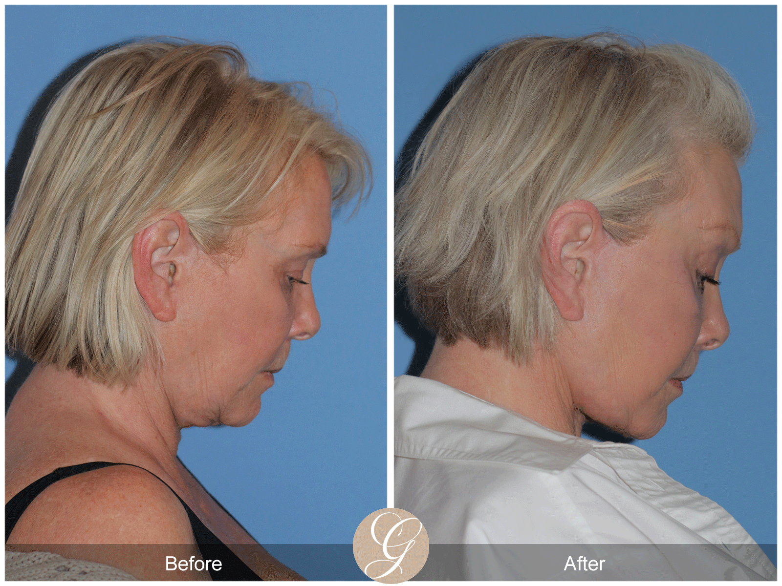 Preservation Deep Plane Facelift Case 48 Image