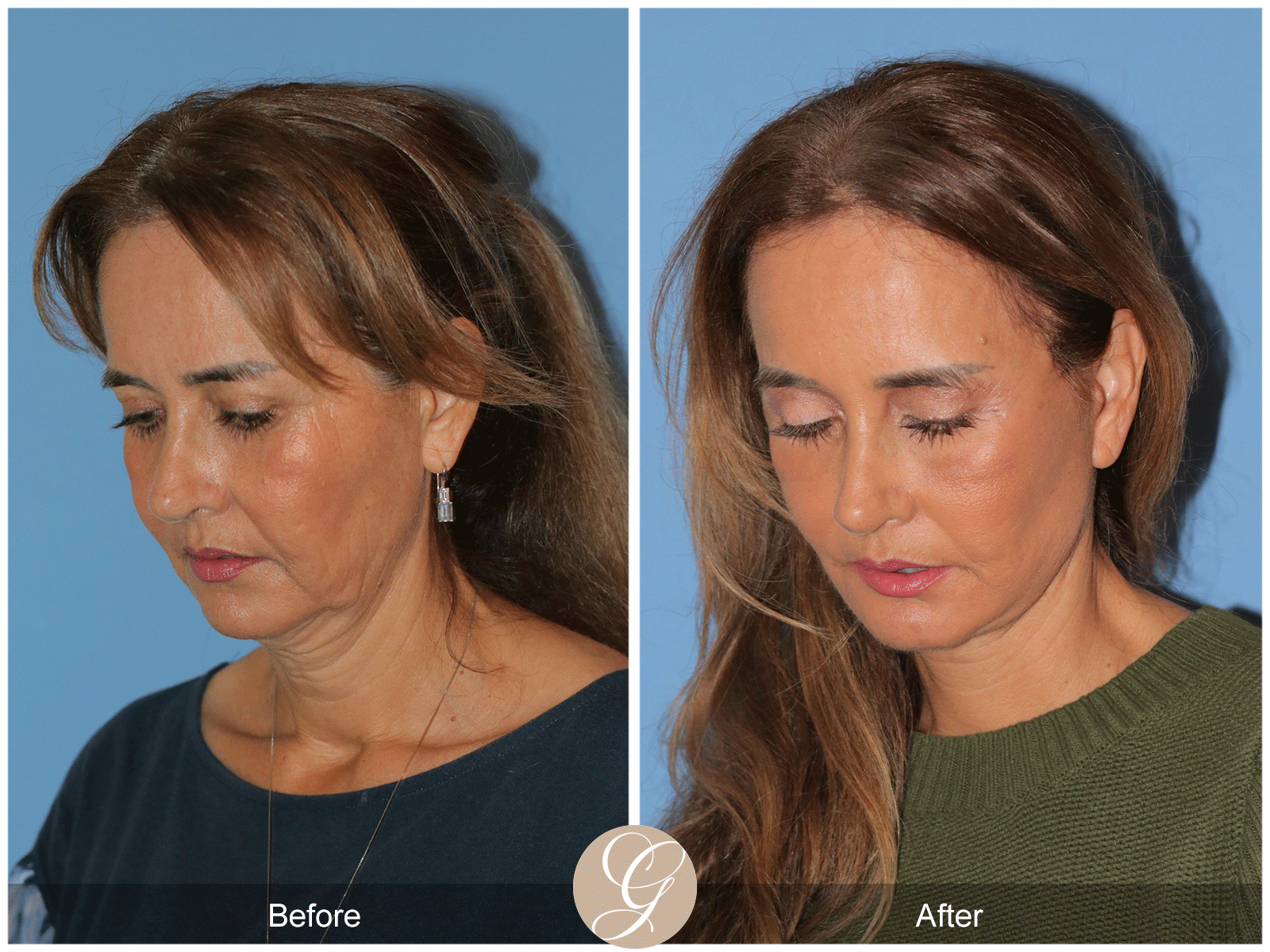 Preservation Deep Plane Facelift Case 49 Image