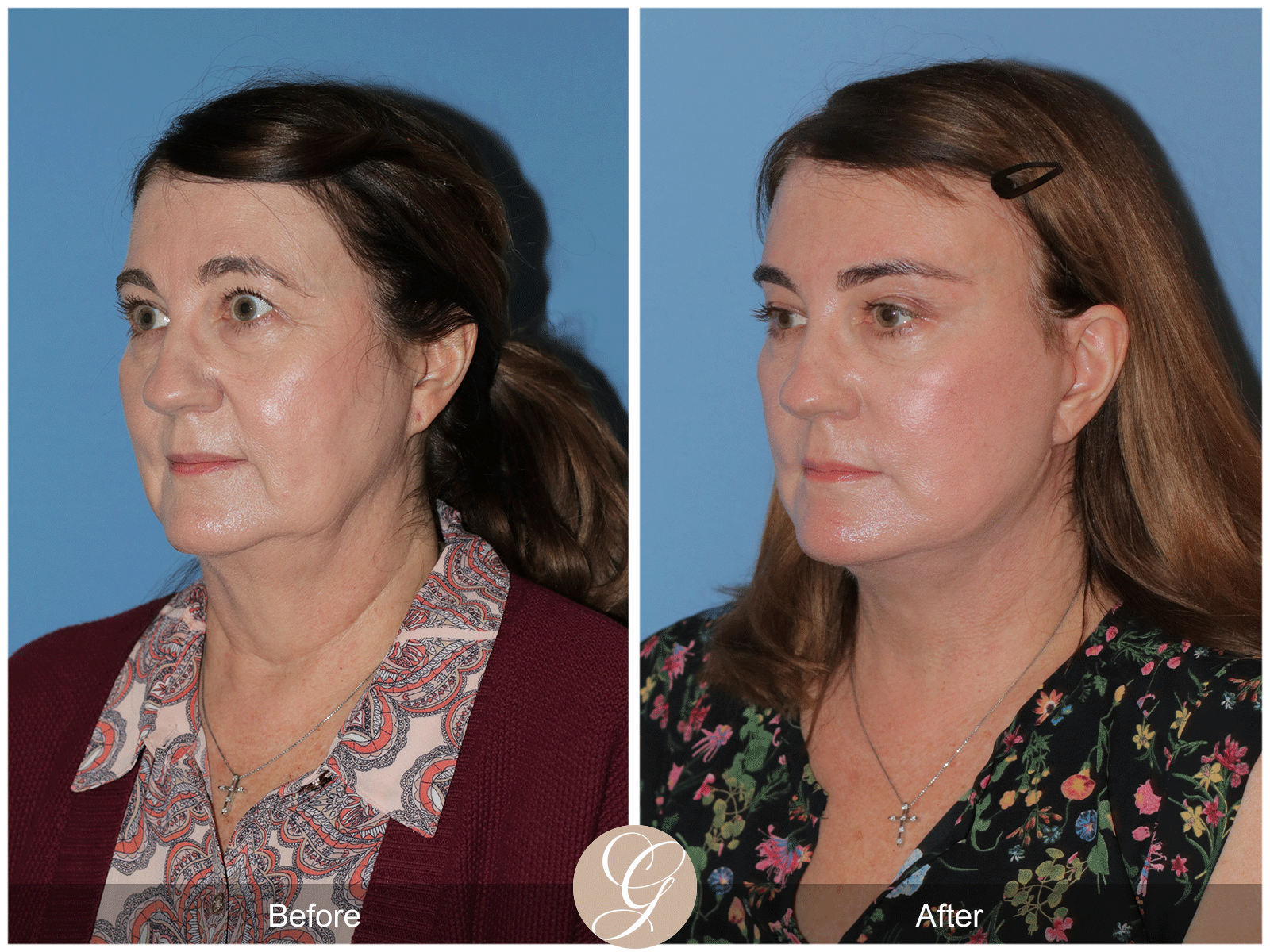 Deep Plane Facelift Case 43 Image