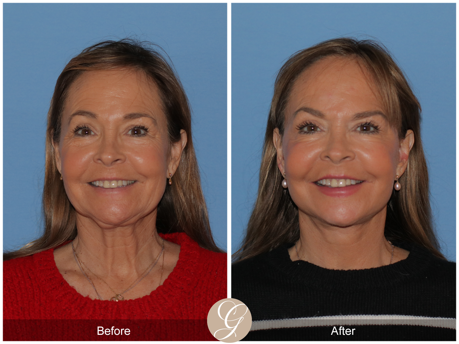 Preservation Deep Plane Facelift Case 45 Image