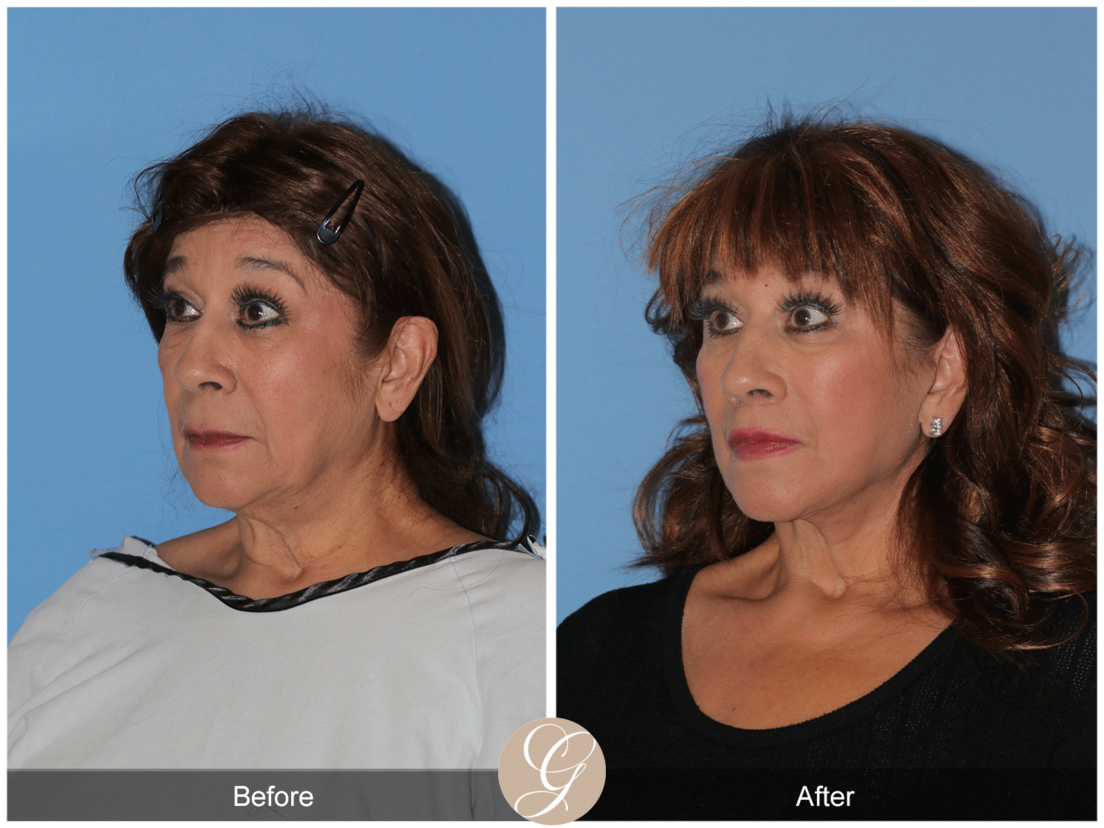 Deep Plane Facelift Case 44 Image