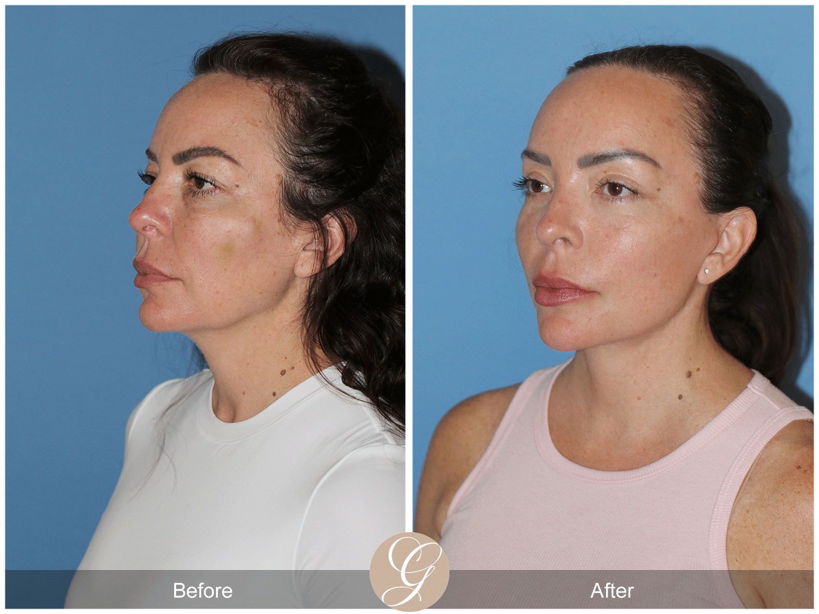 Preservation Deep Plane Facelift Case 46 Image