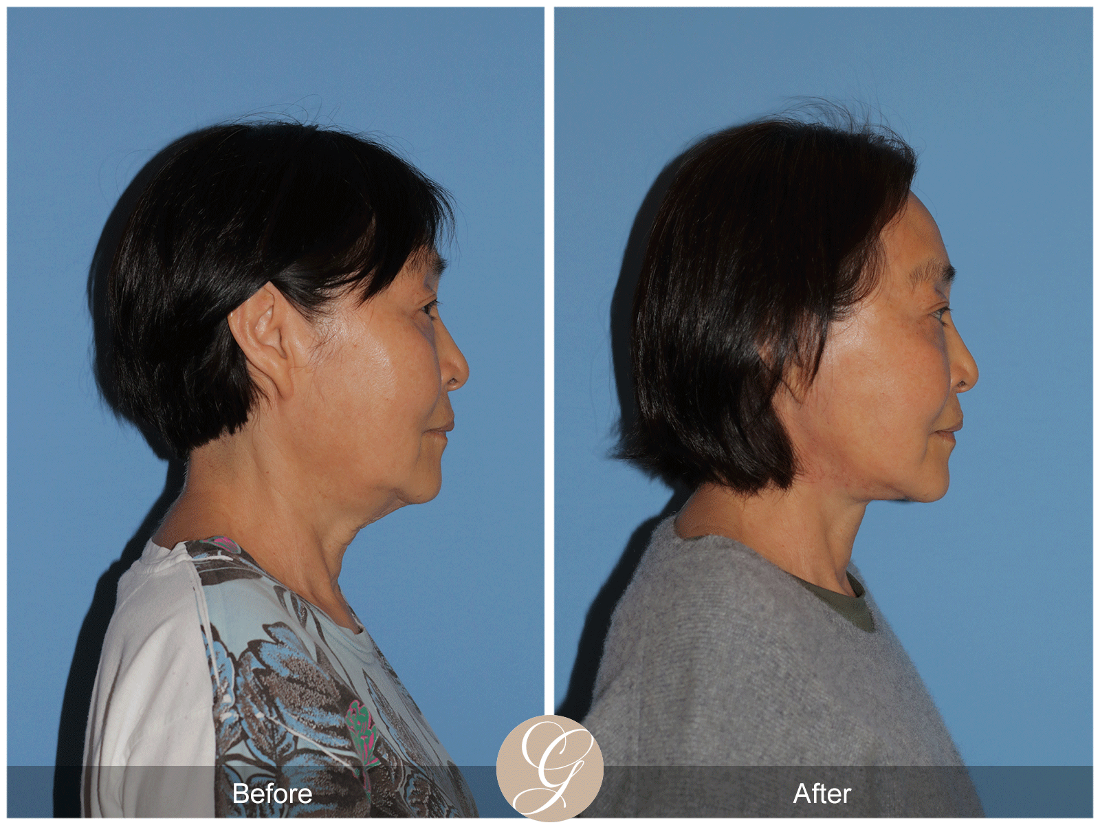 Deep Plane Facelift Case 45 Image