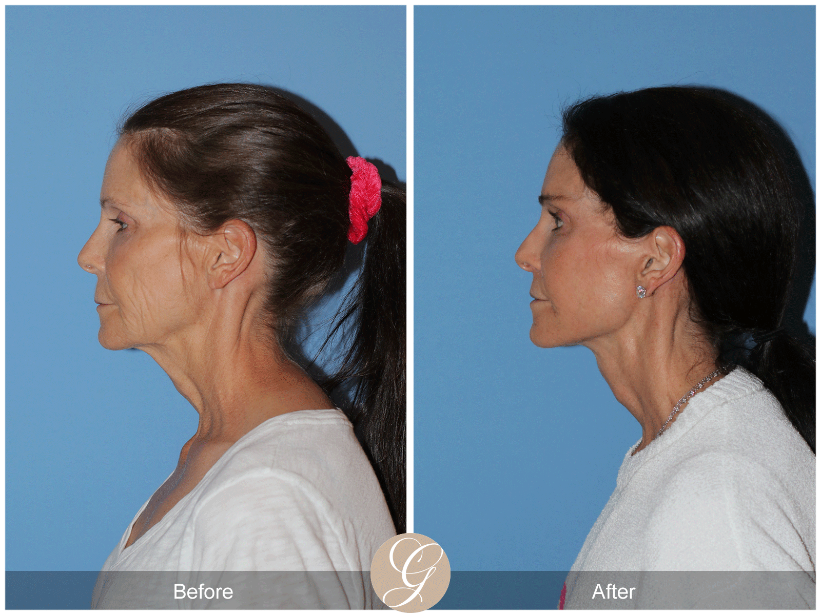 Deep Plane Facelift Case 46 Image