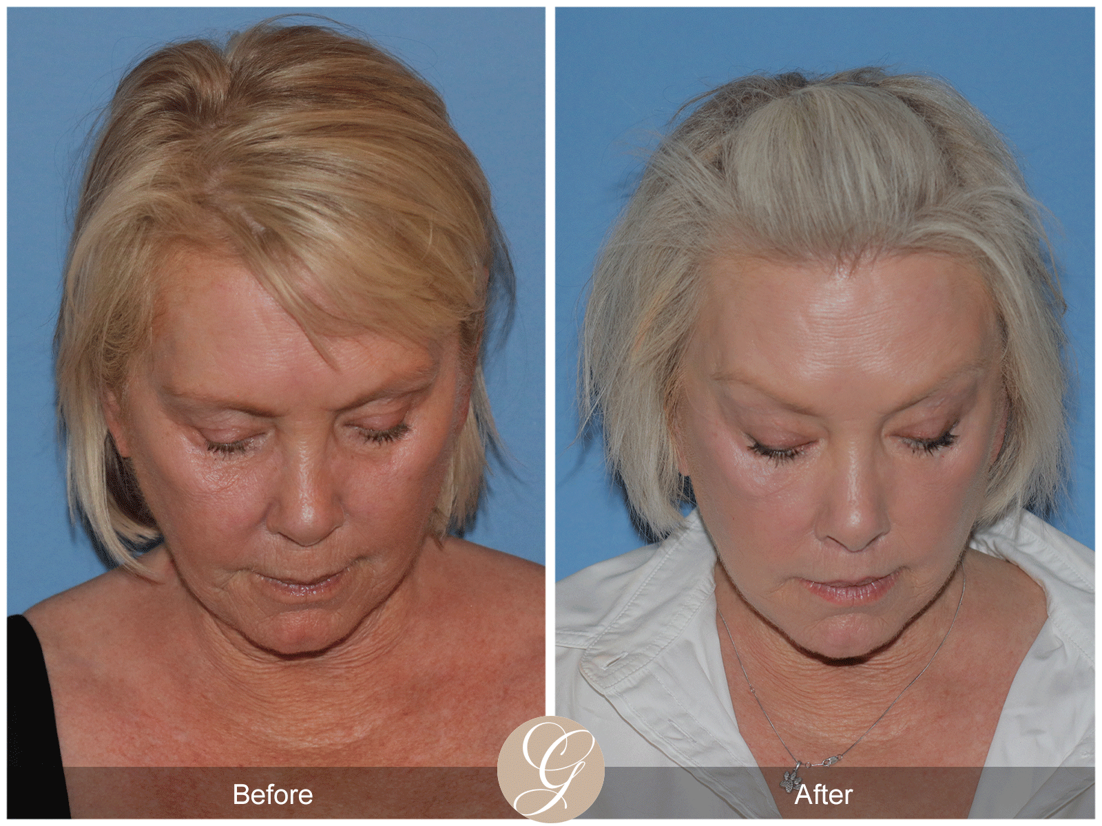 Preservation Deep Plane Facelift Case 48 Image