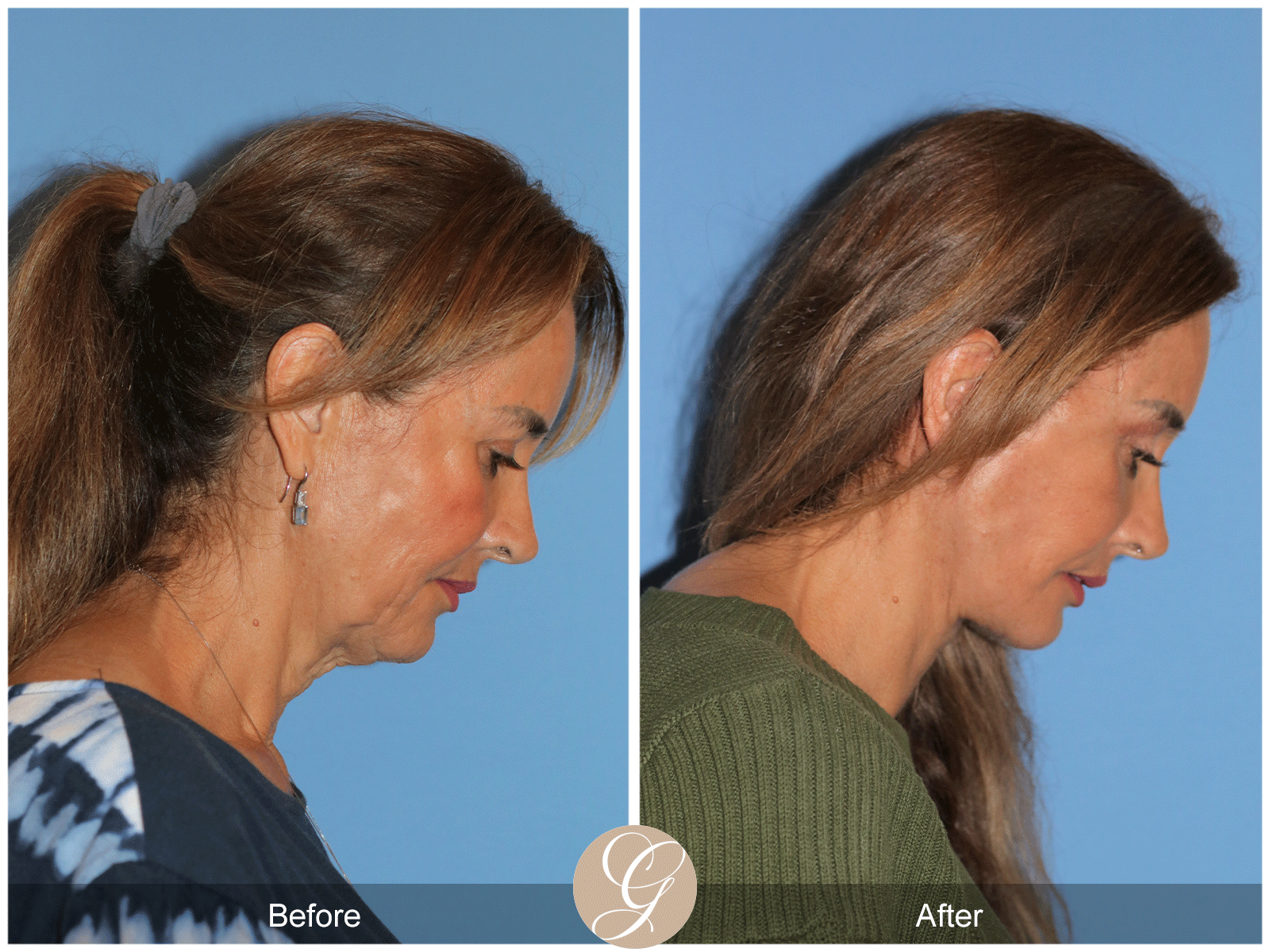 Preservation Deep Plane Facelift Case 49 Image