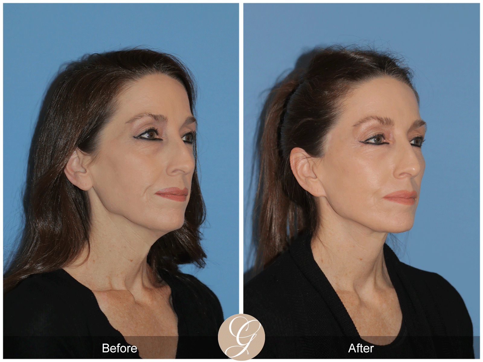 Deep Plane Facelift Case 38 Image