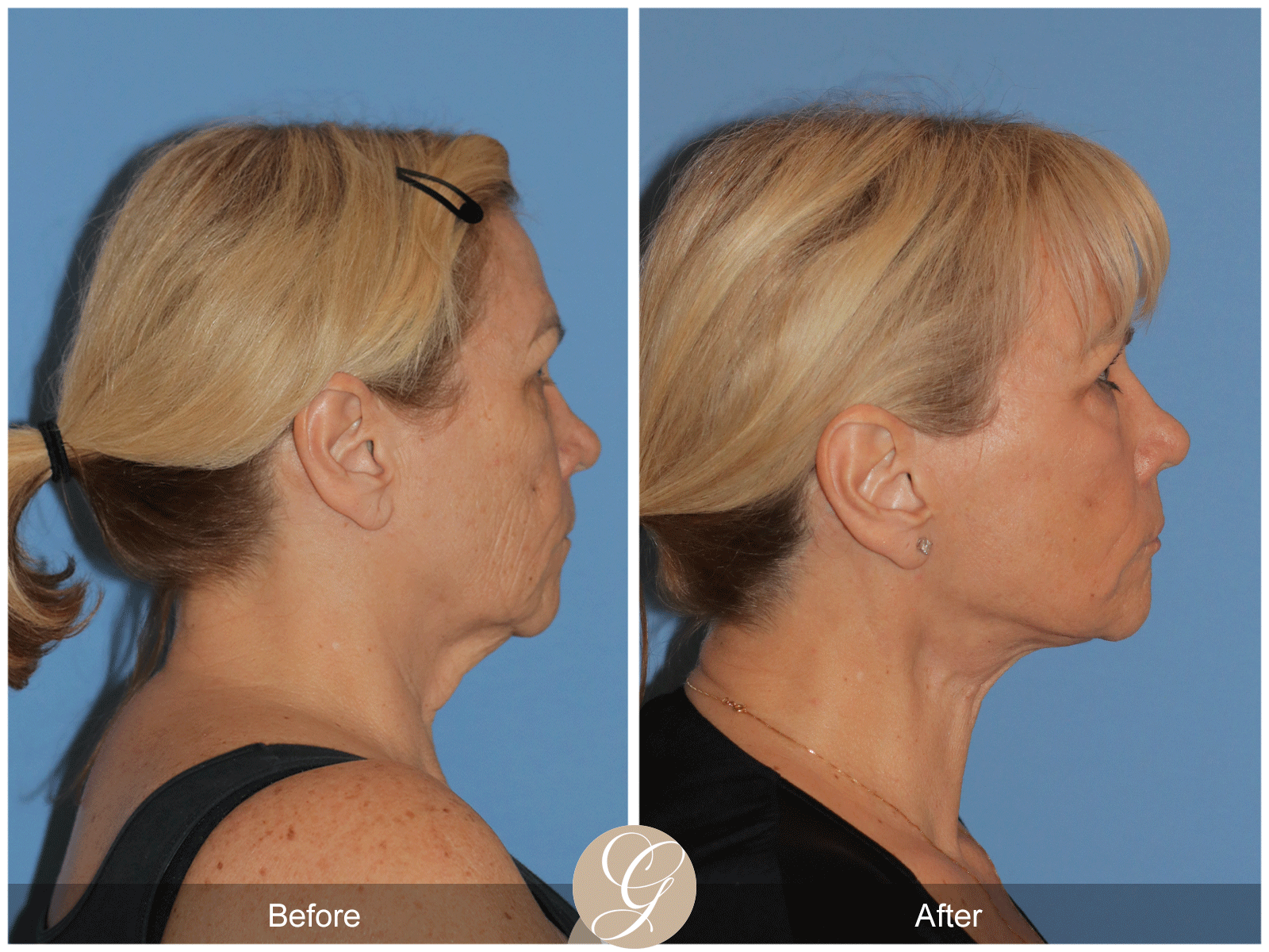 Deep Plane Facelift Case 38 Image