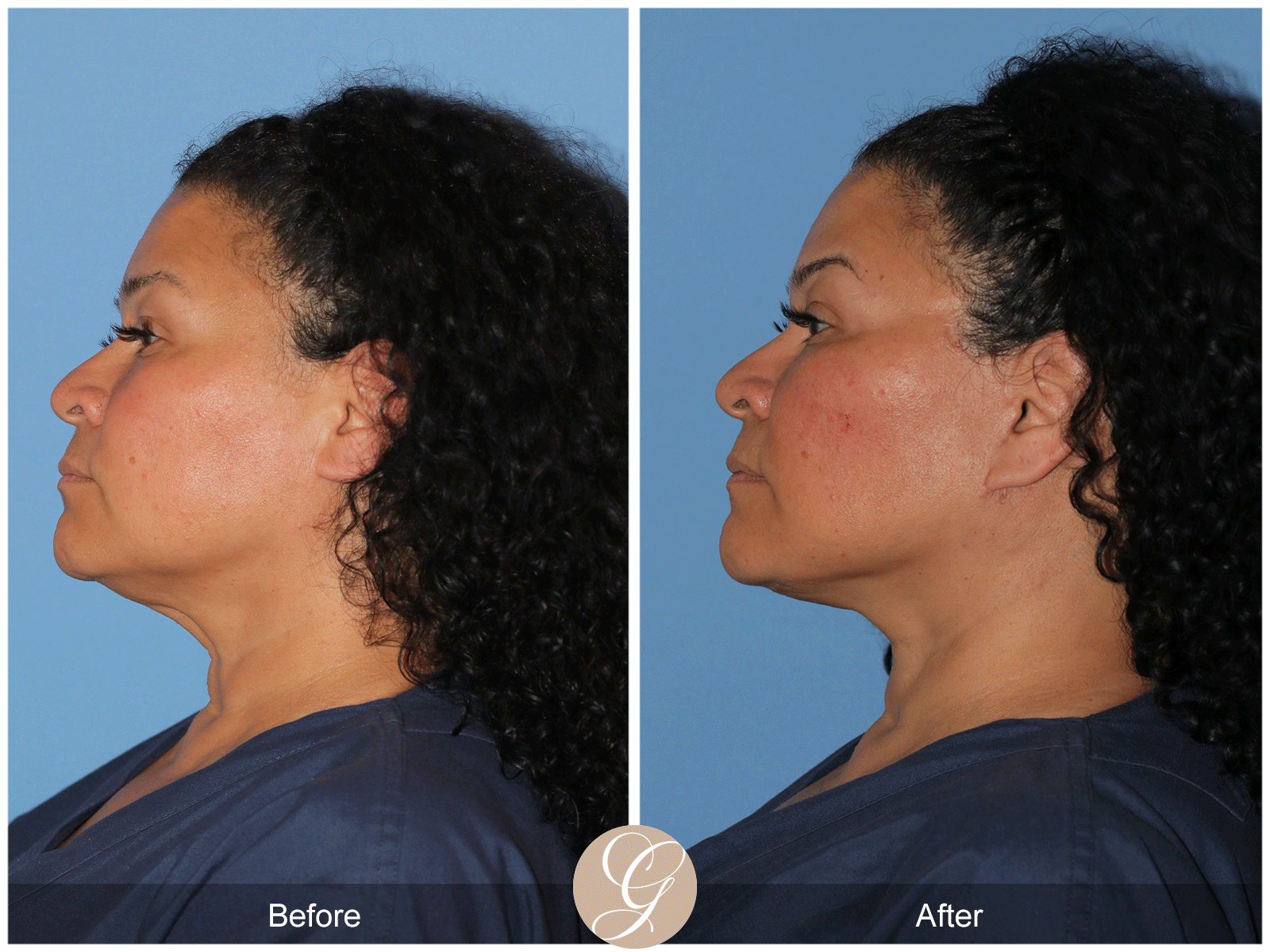 Deep Plane Facelift Case 40 Image