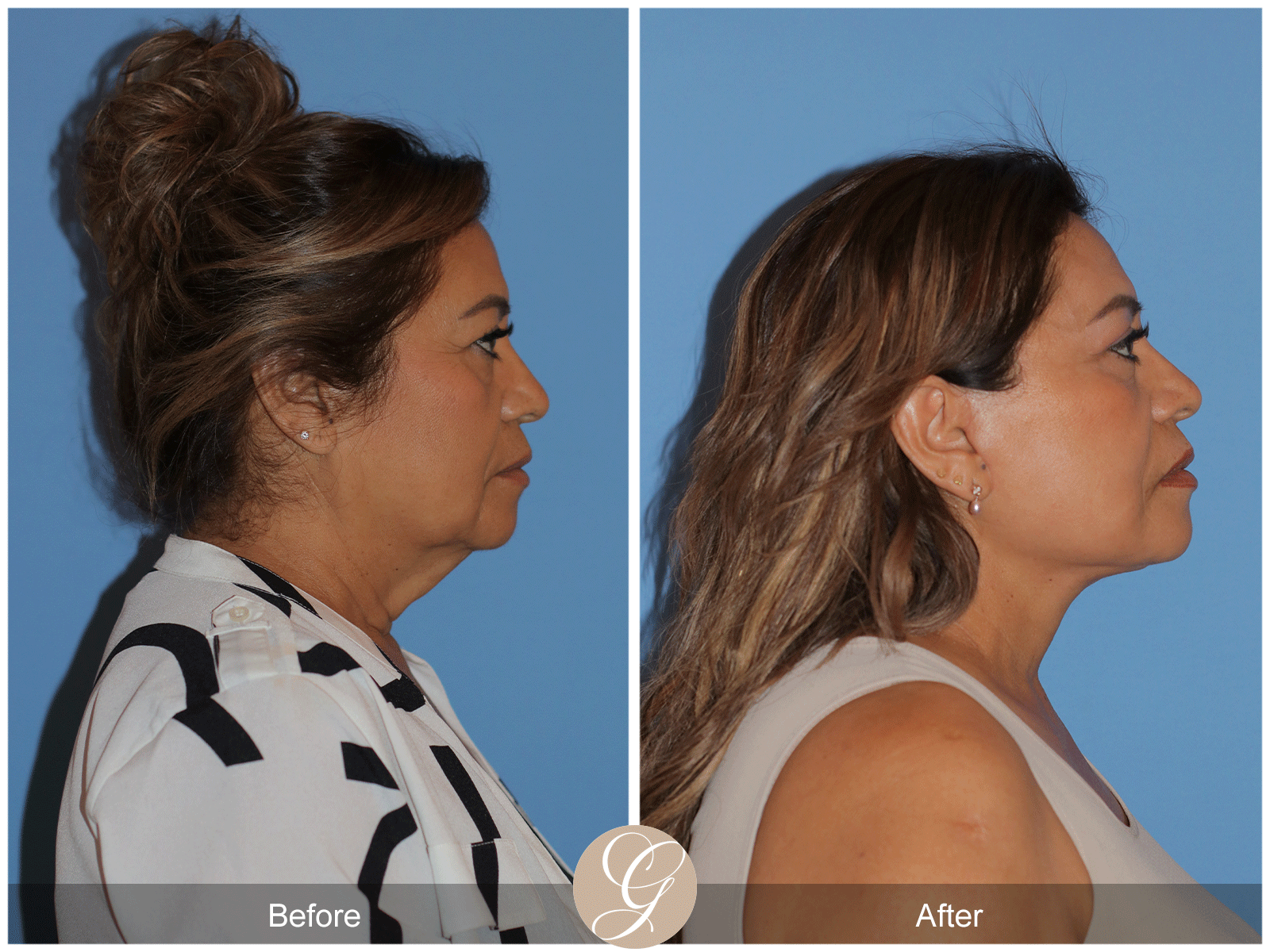 Preservation Deep Plane Facelift Case 41 Image