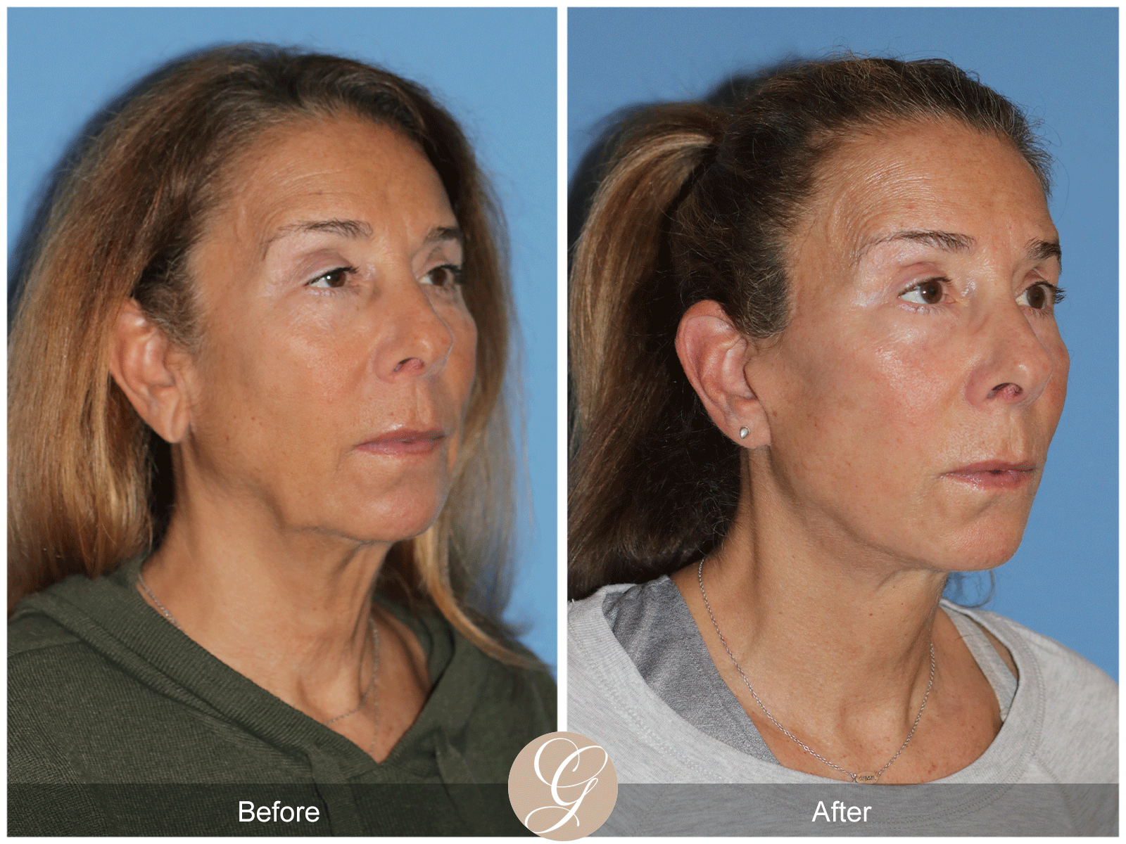 Preservation Deep Plane Facelift Case 43 Image