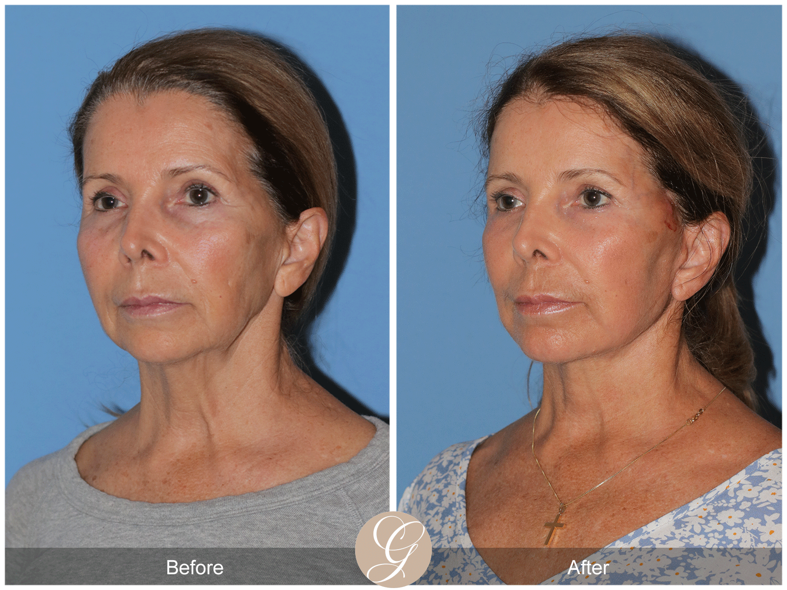 Preservation Deep Plane Facelift Case 44 Image