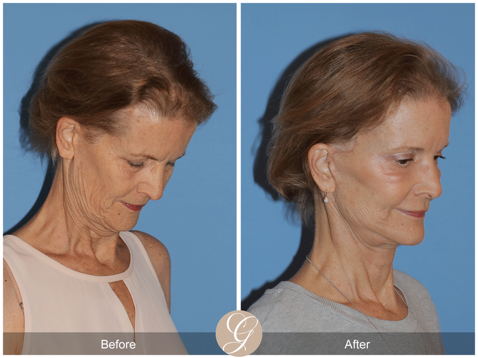 Deep Plane Facelift Case 36 Image