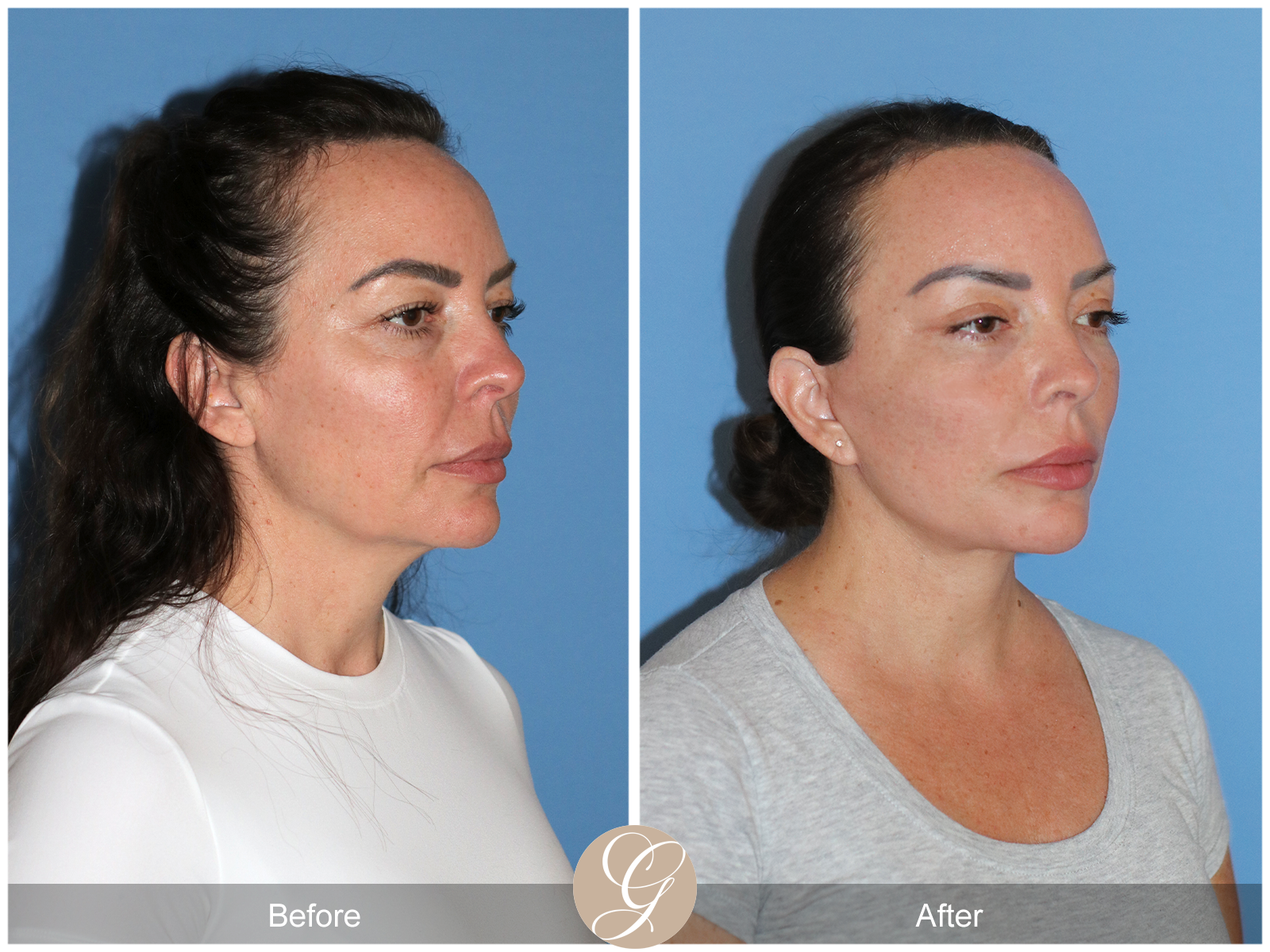 Preservation Deep Plane Facelift Case 46 Image