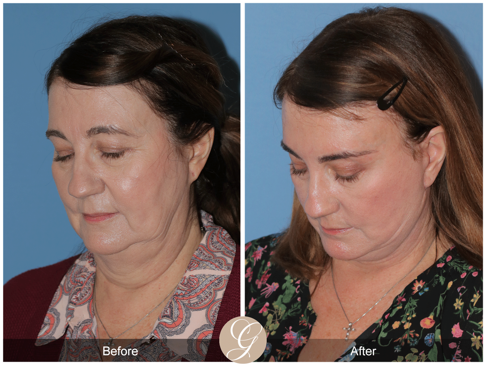 Deep Plane Facelift Case 43 Image