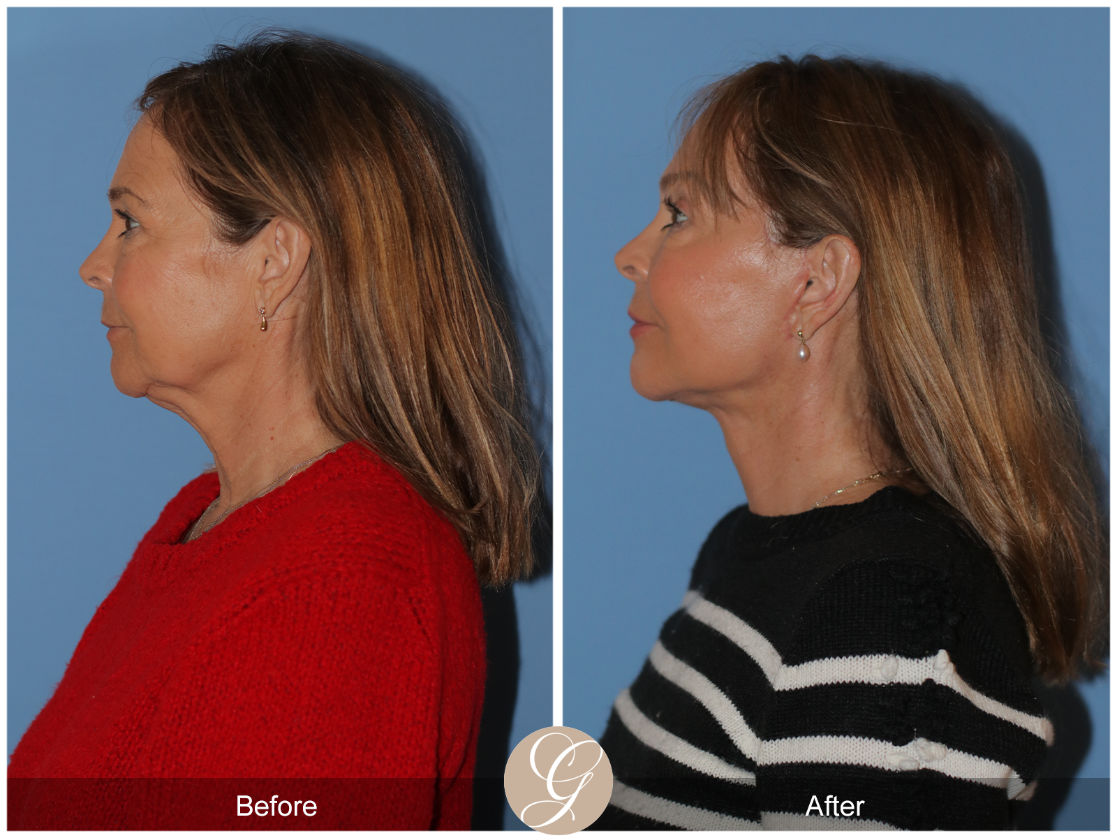 Preservation Deep Plane Facelift Case 45 Image