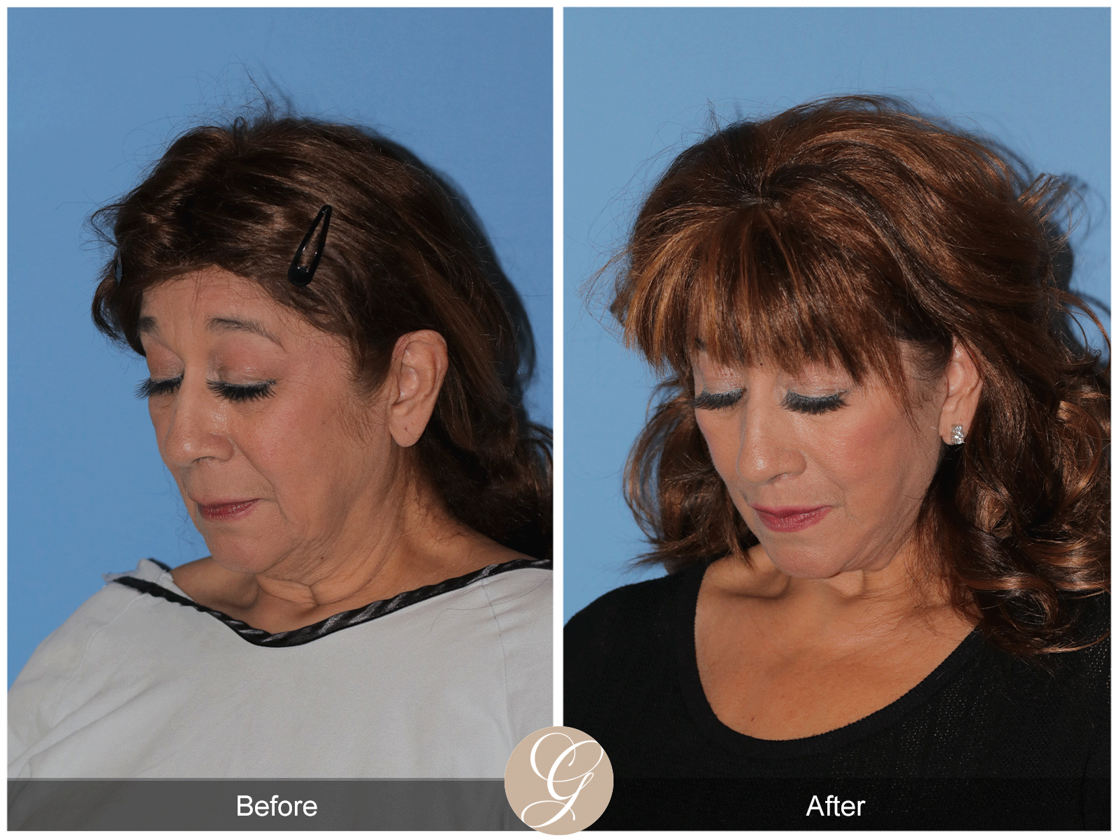 Deep Plane Facelift Case 44 Image