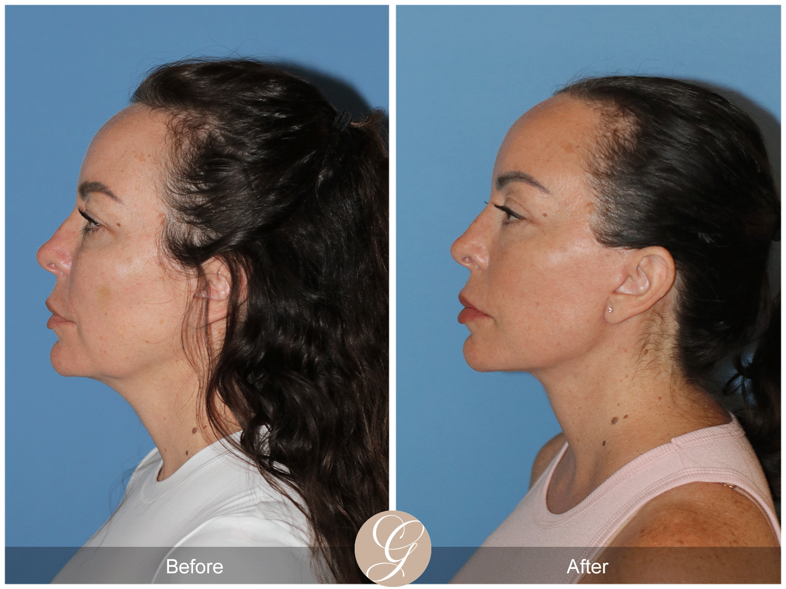 Preservation Deep Plane Facelift Case 46 Image