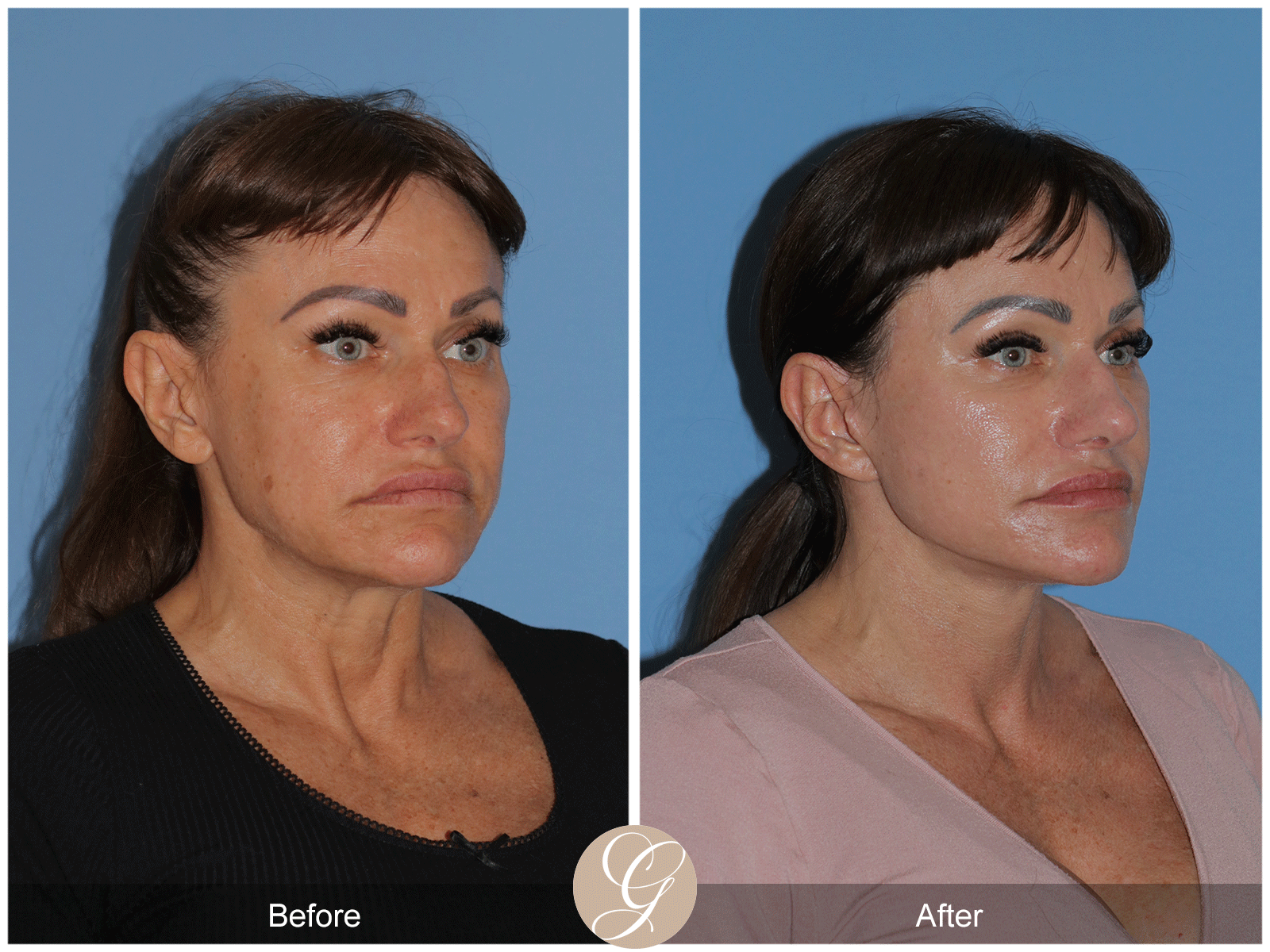 Preservation Deep Plane Facelift Case 47 Image