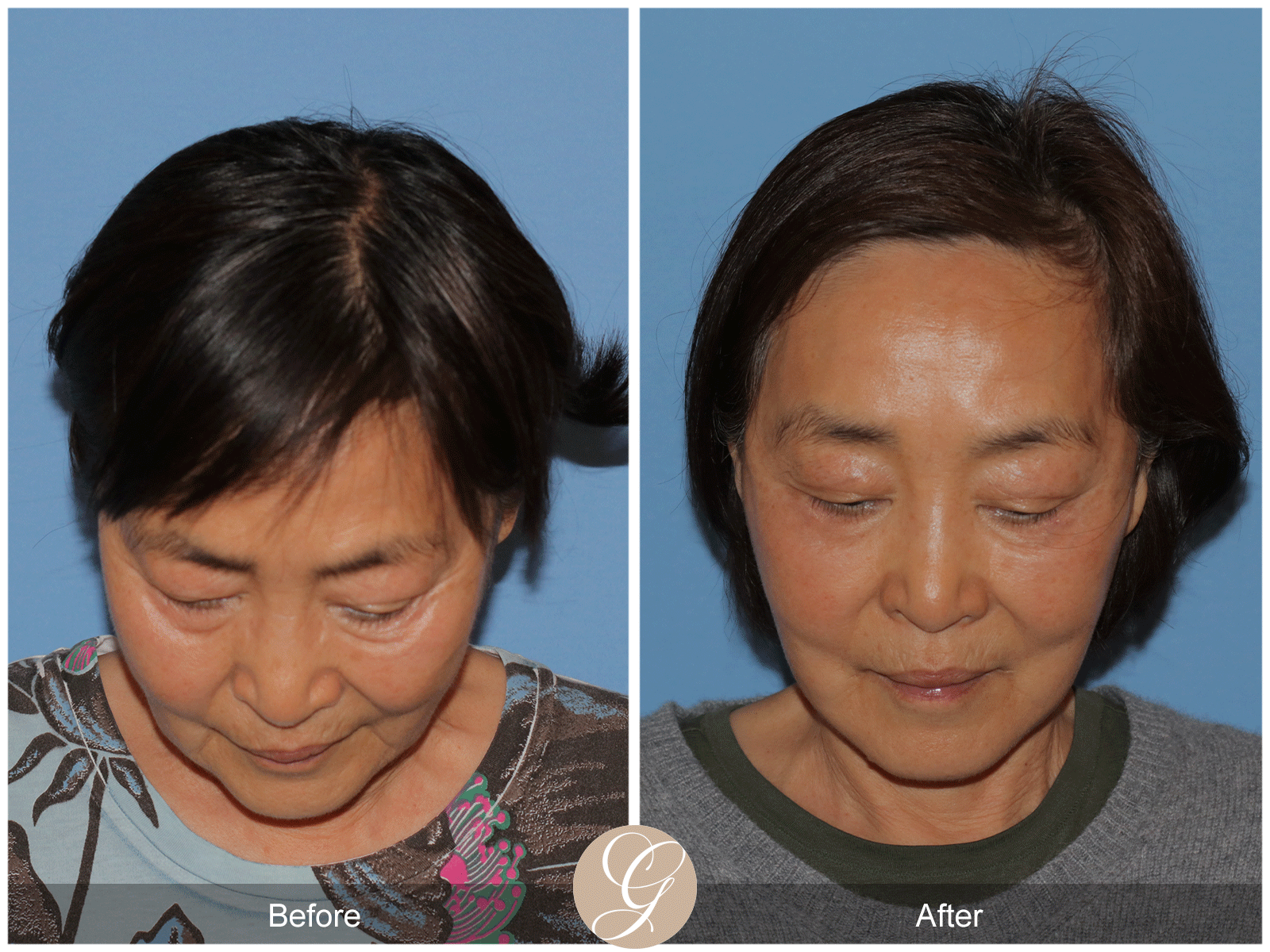 Deep Plane Facelift Case 45 Image