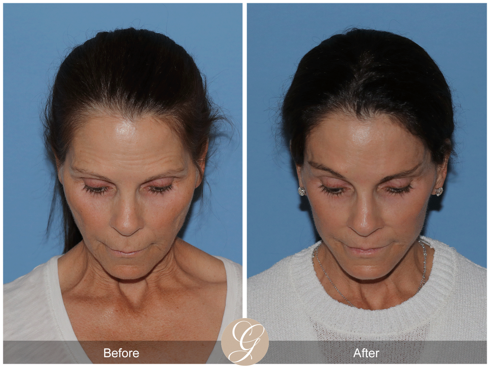 Deep Plane Facelift Case 46 Image