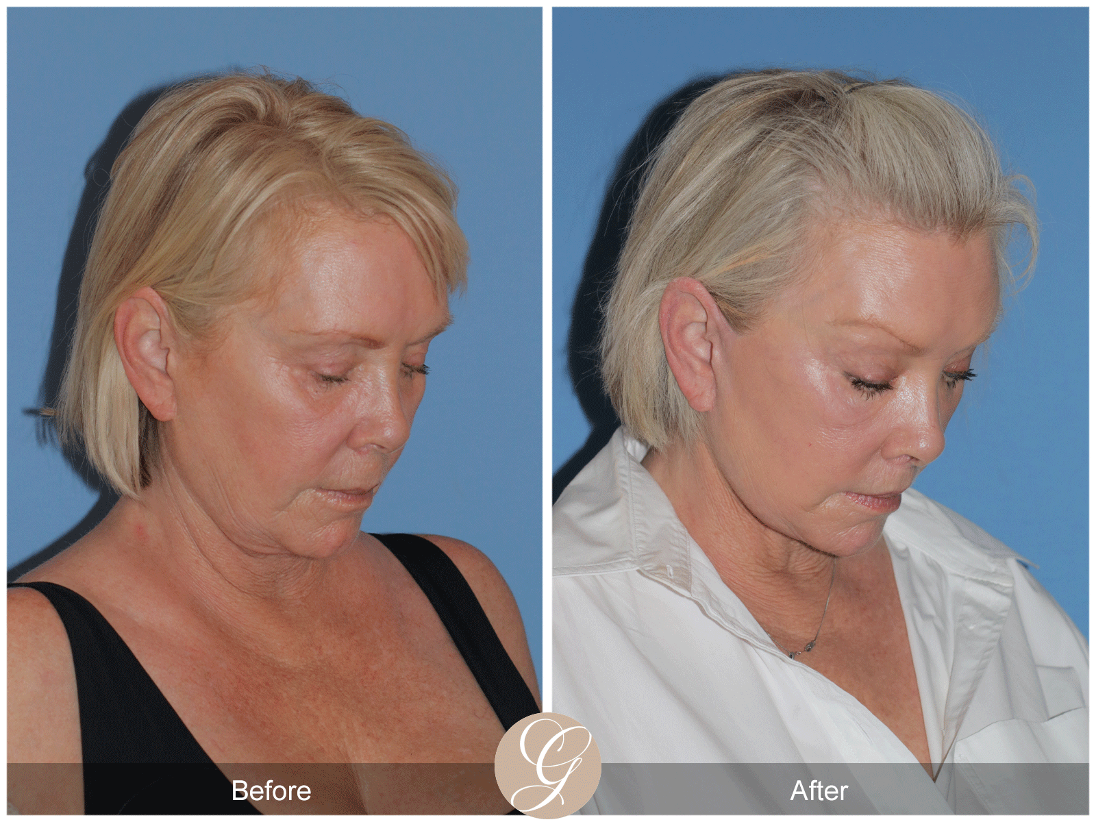 Preservation Deep Plane Facelift Case 48 Image
