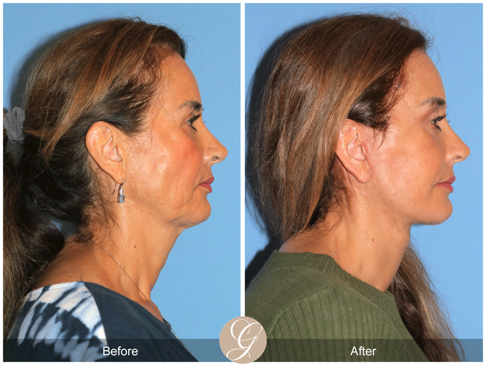 Preservation Deep Plane Facelift Case 49 Image