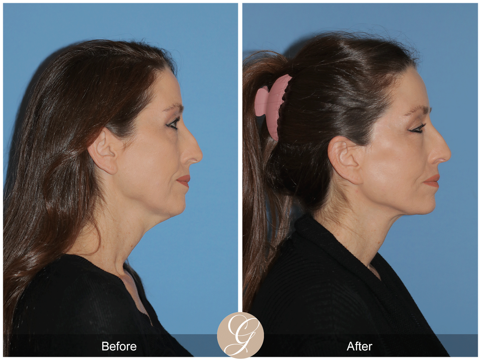 Deep Plane Facelift Case 38 Image