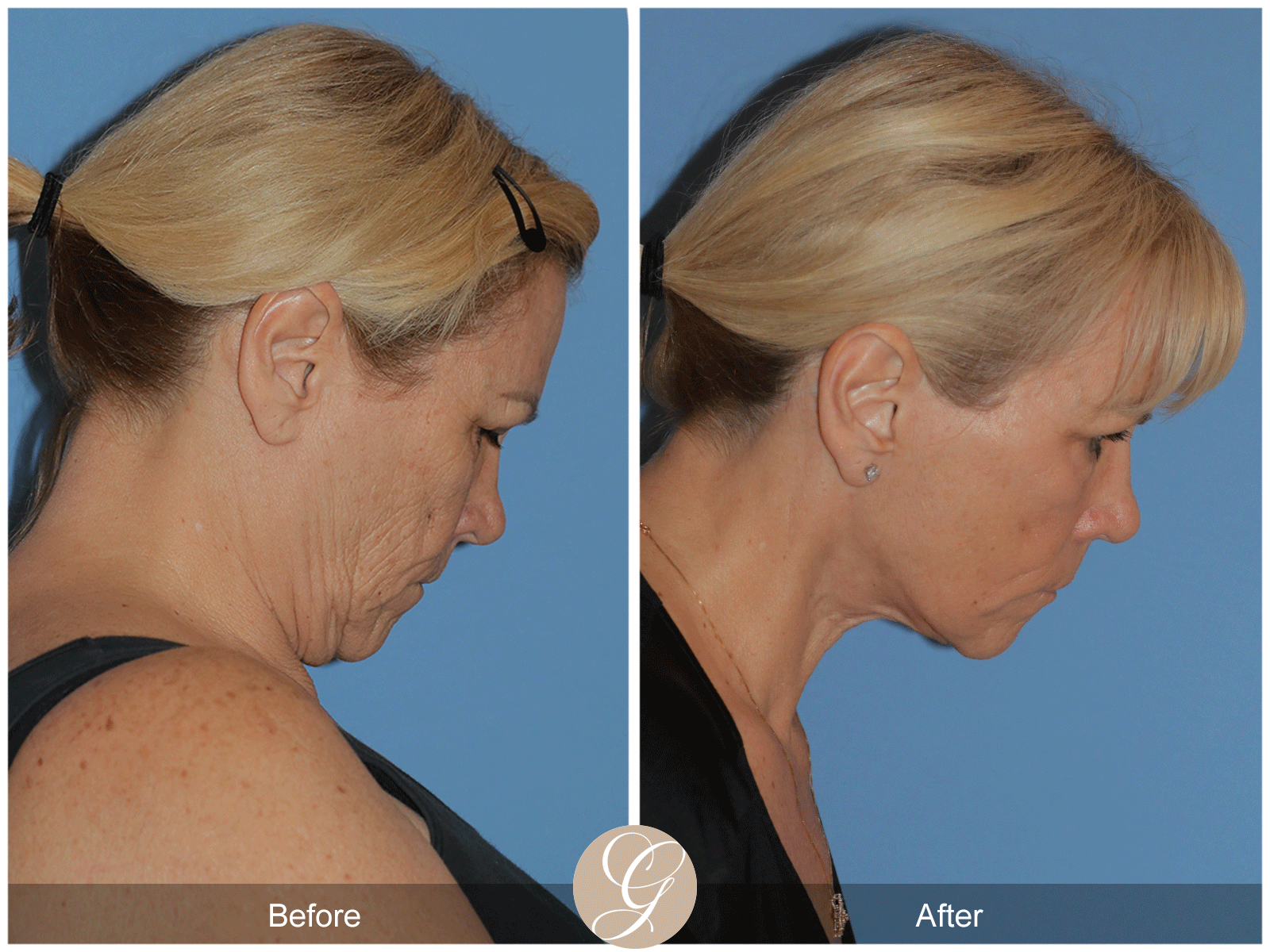 Deep Plane Facelift Case 38 Image