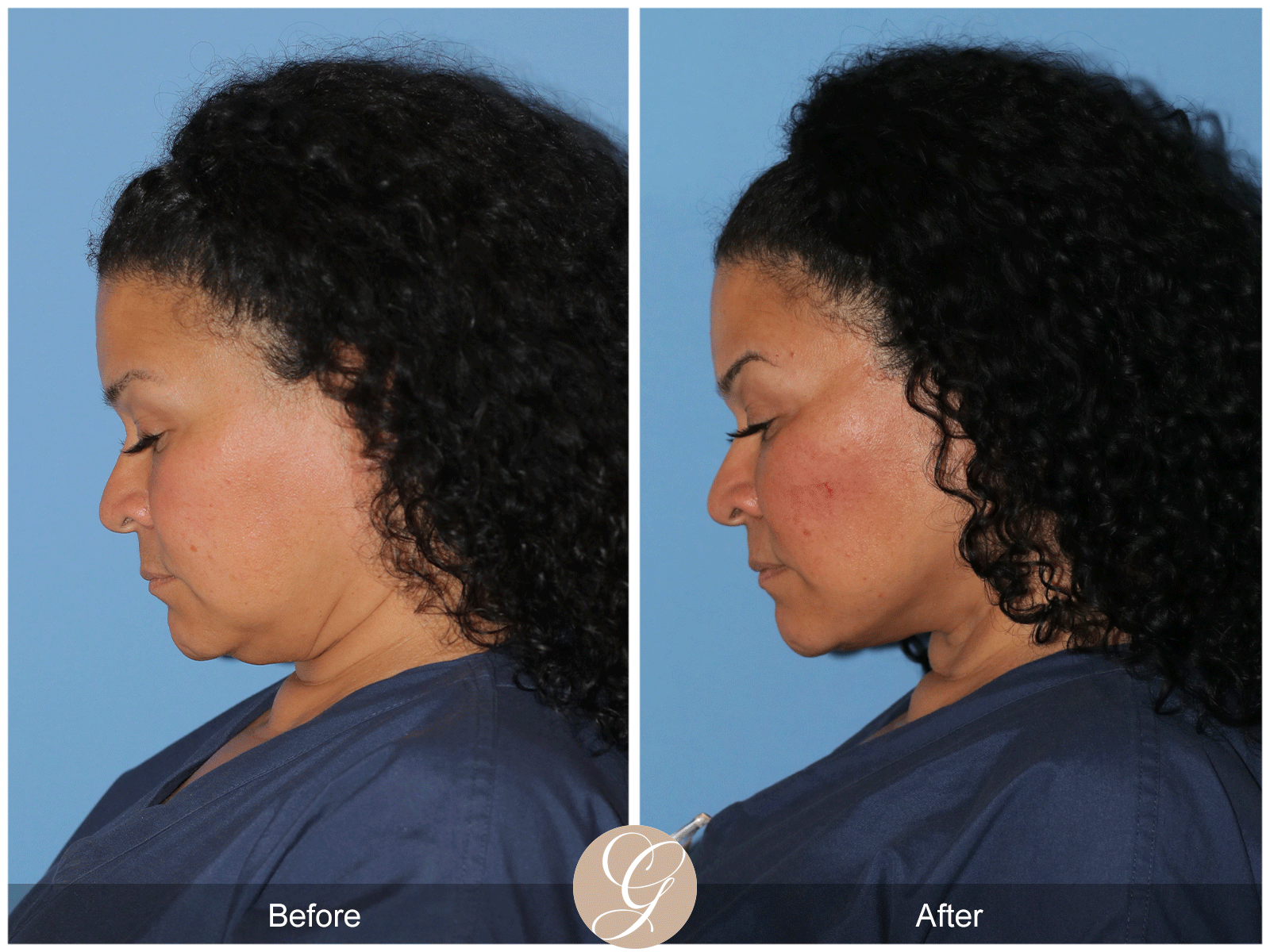 Deep Plane Facelift Case 40 Image