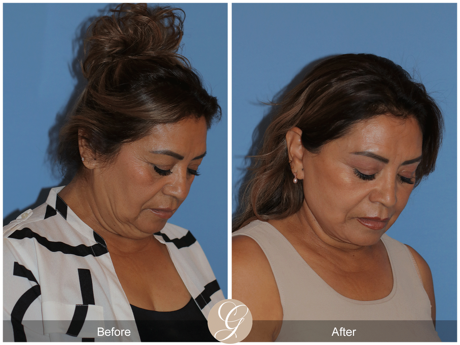 Preservation Deep Plane Facelift Case 41 Image