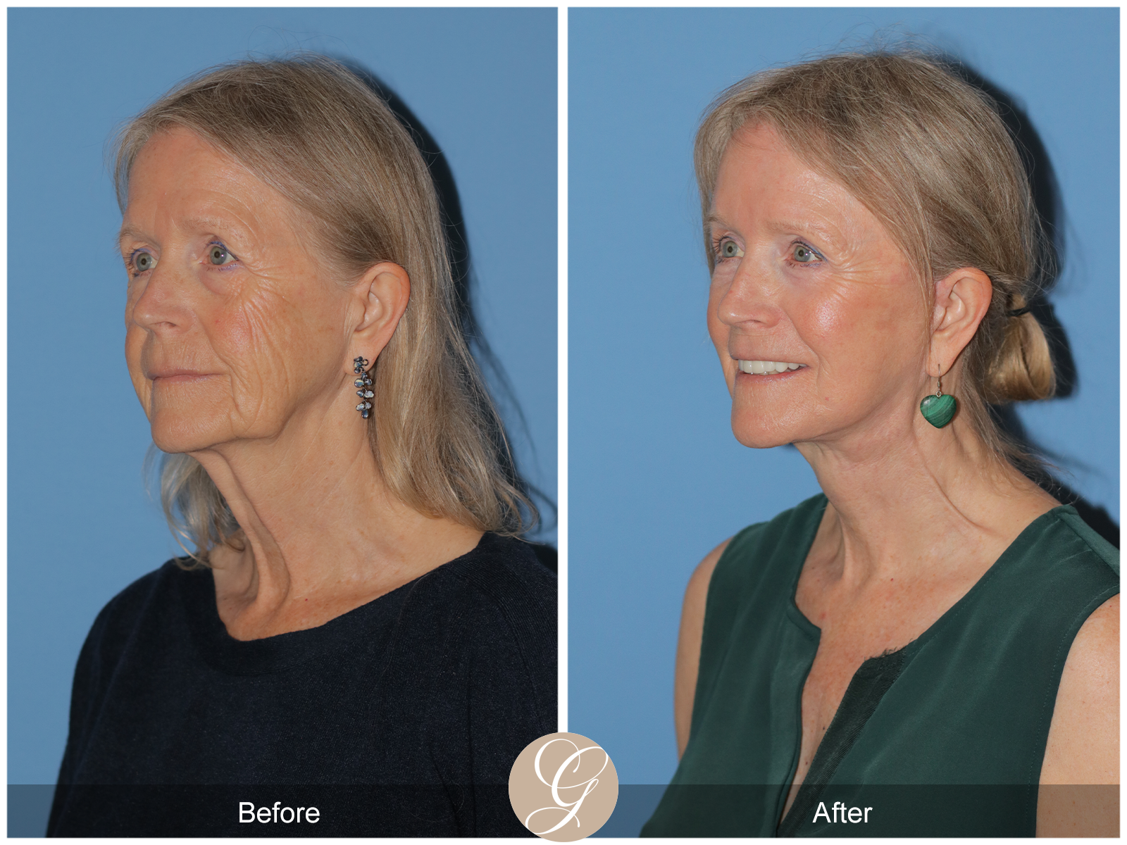 Preservation Deep Plane Facelift Case 42 Image