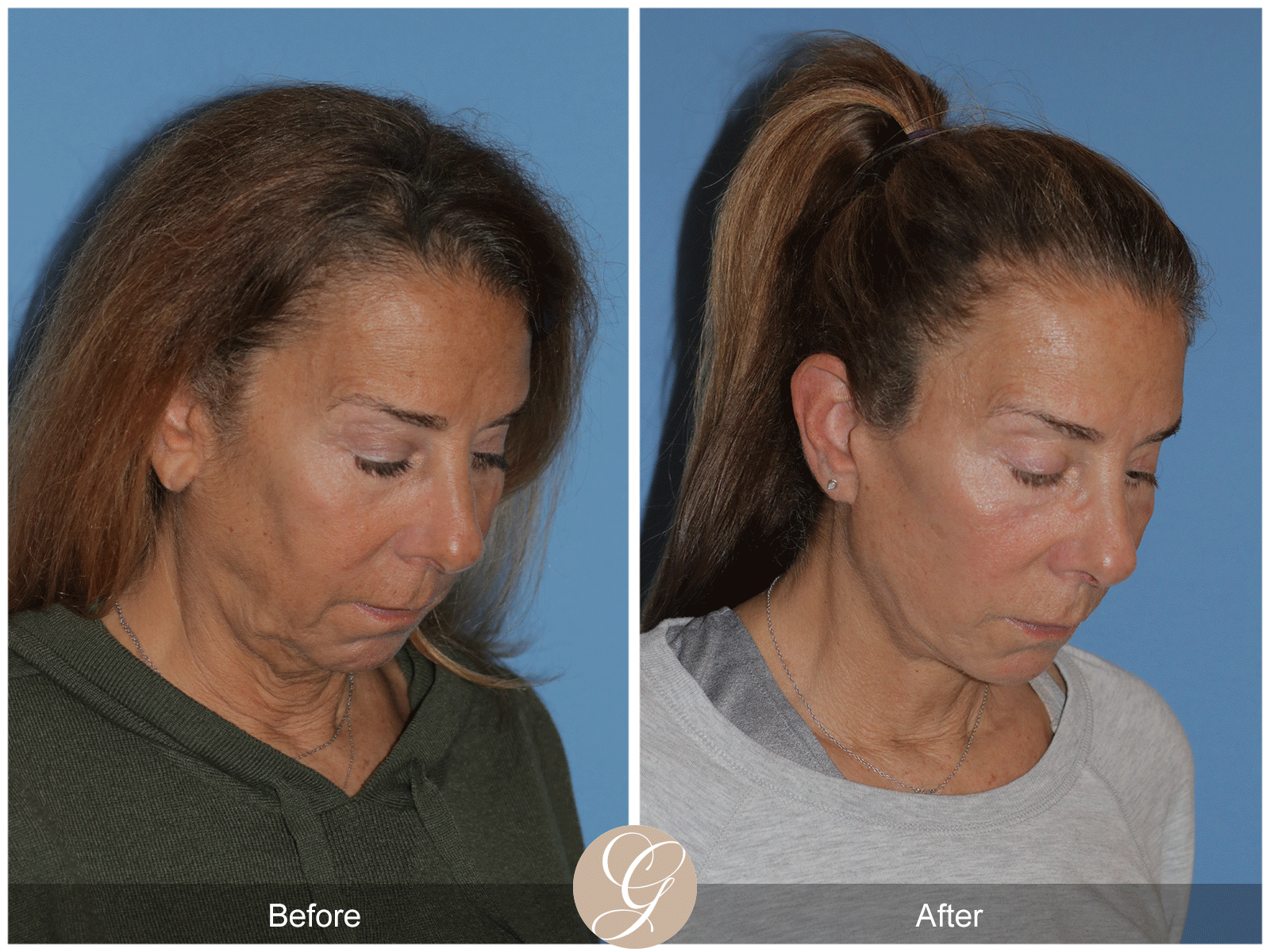 Preservation Deep Plane Facelift Case 43 Image