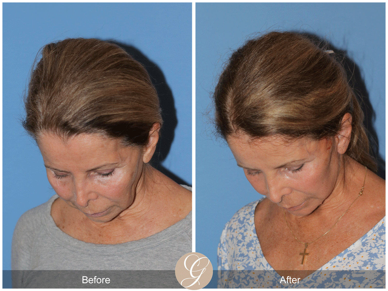Preservation Deep Plane Facelift Case 44 Image
