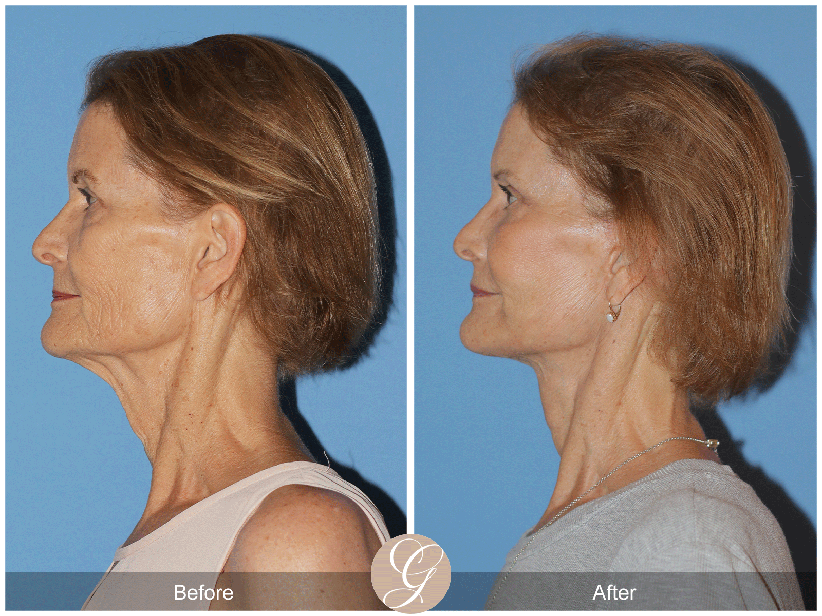 Deep Plane Facelift Case 36 Image