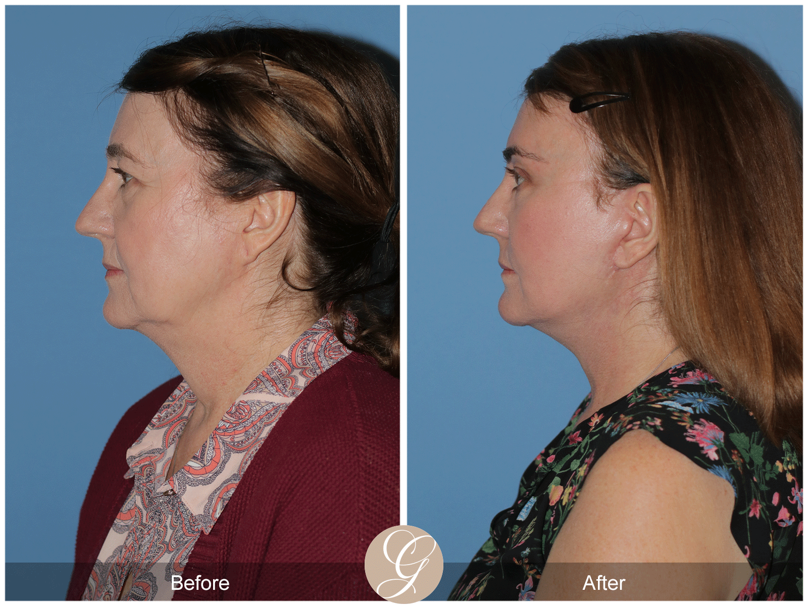 Deep Plane Facelift Case 43 Image