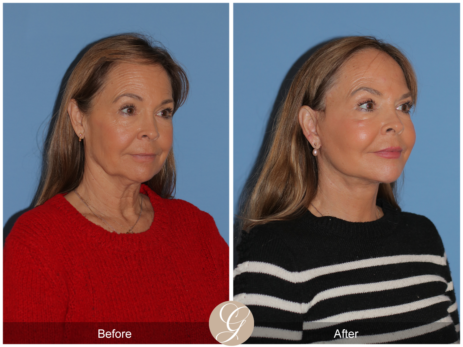 Preservation Deep Plane Facelift Case 45 Image