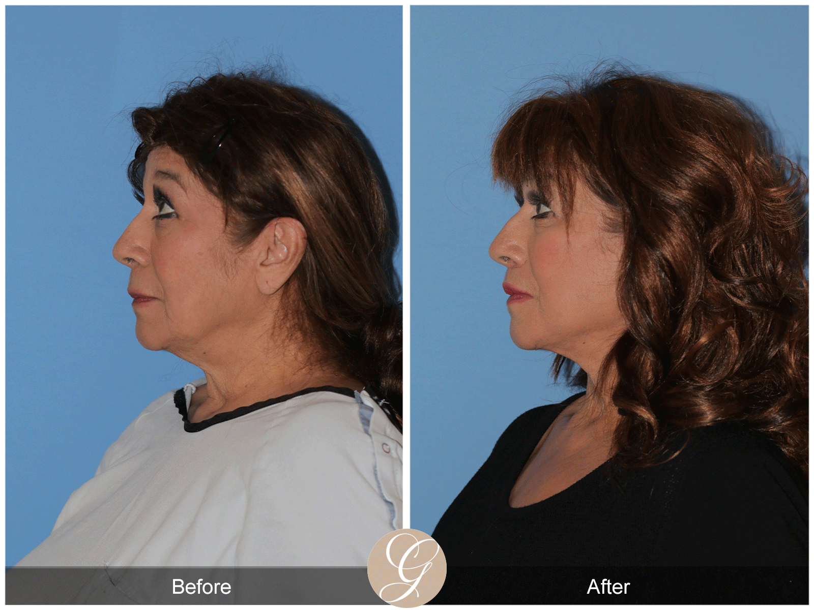 Deep Plane Facelift Case 44 Image