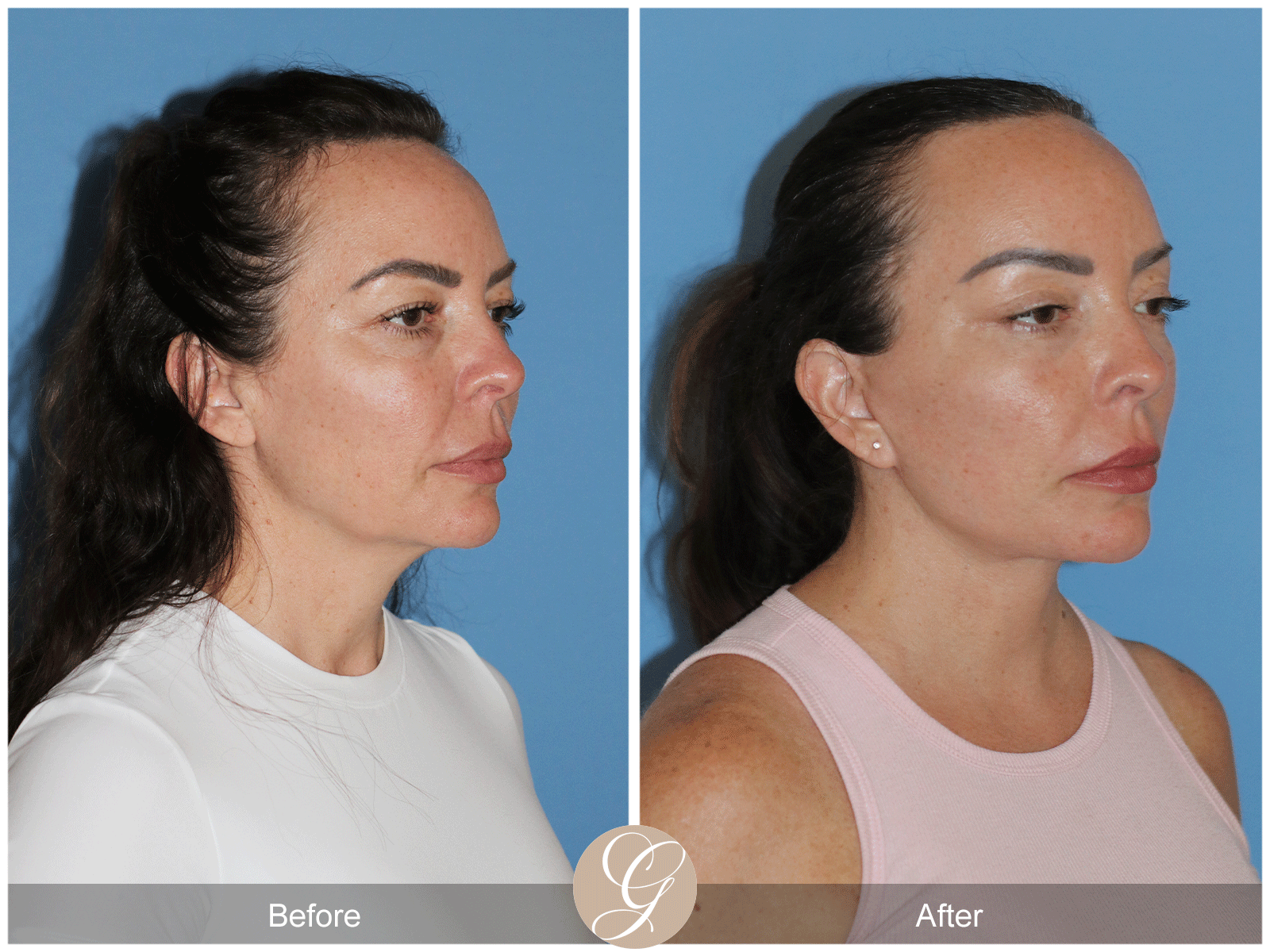 Preservation Deep Plane Facelift Case 46 Image