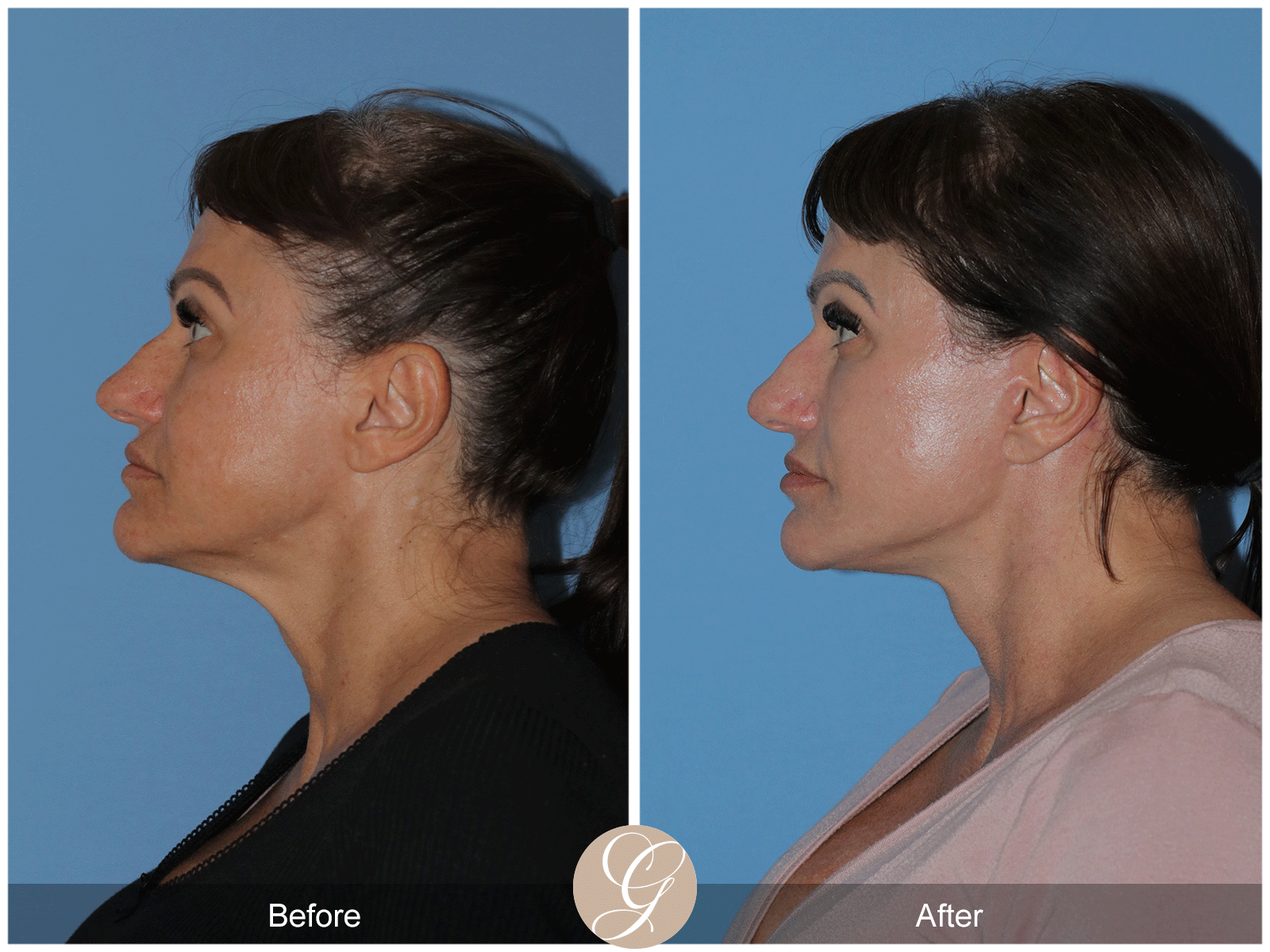 Preservation Deep Plane Facelift Case 47 Image