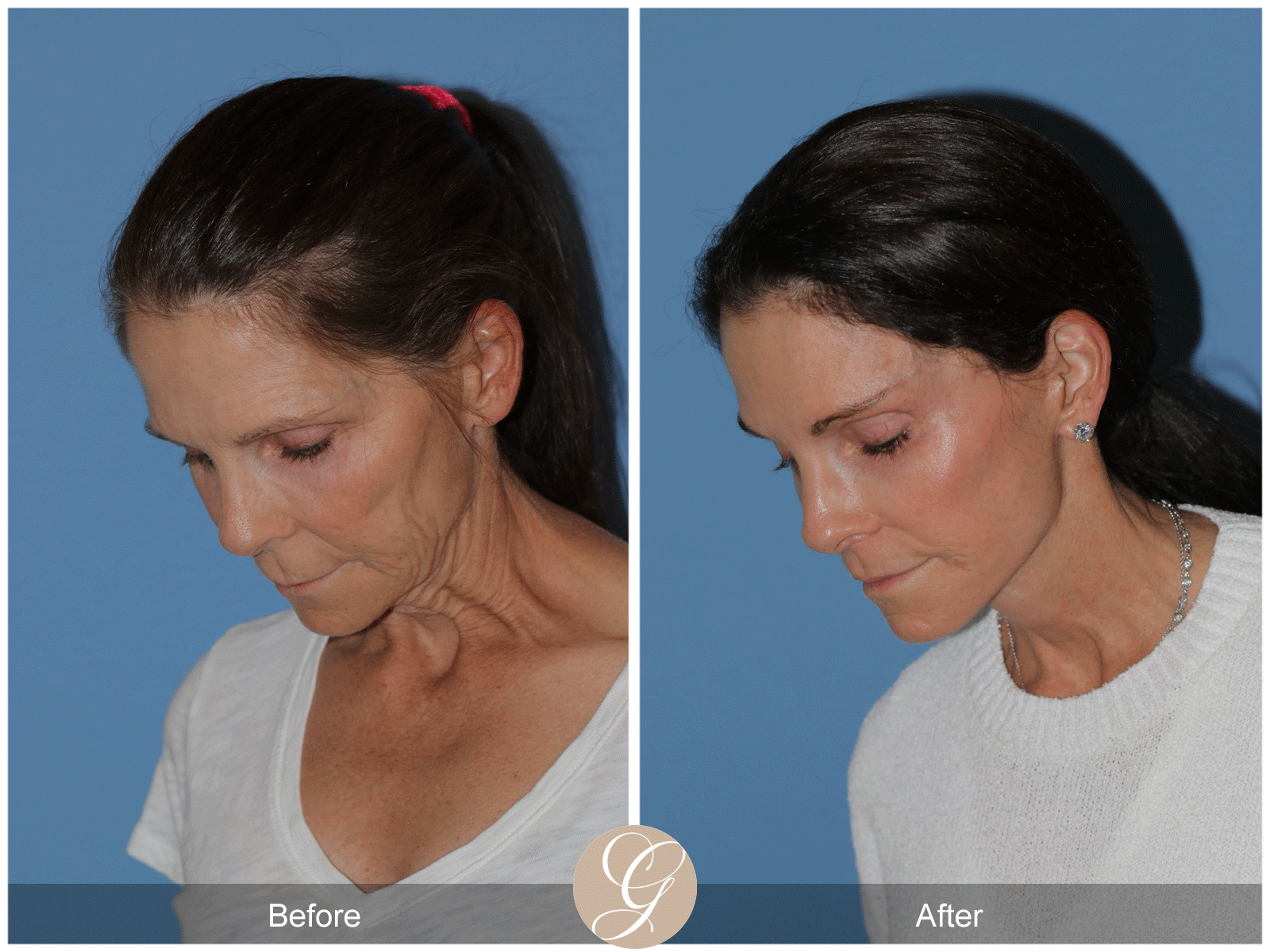 Deep Plane Facelift Case 46 Image